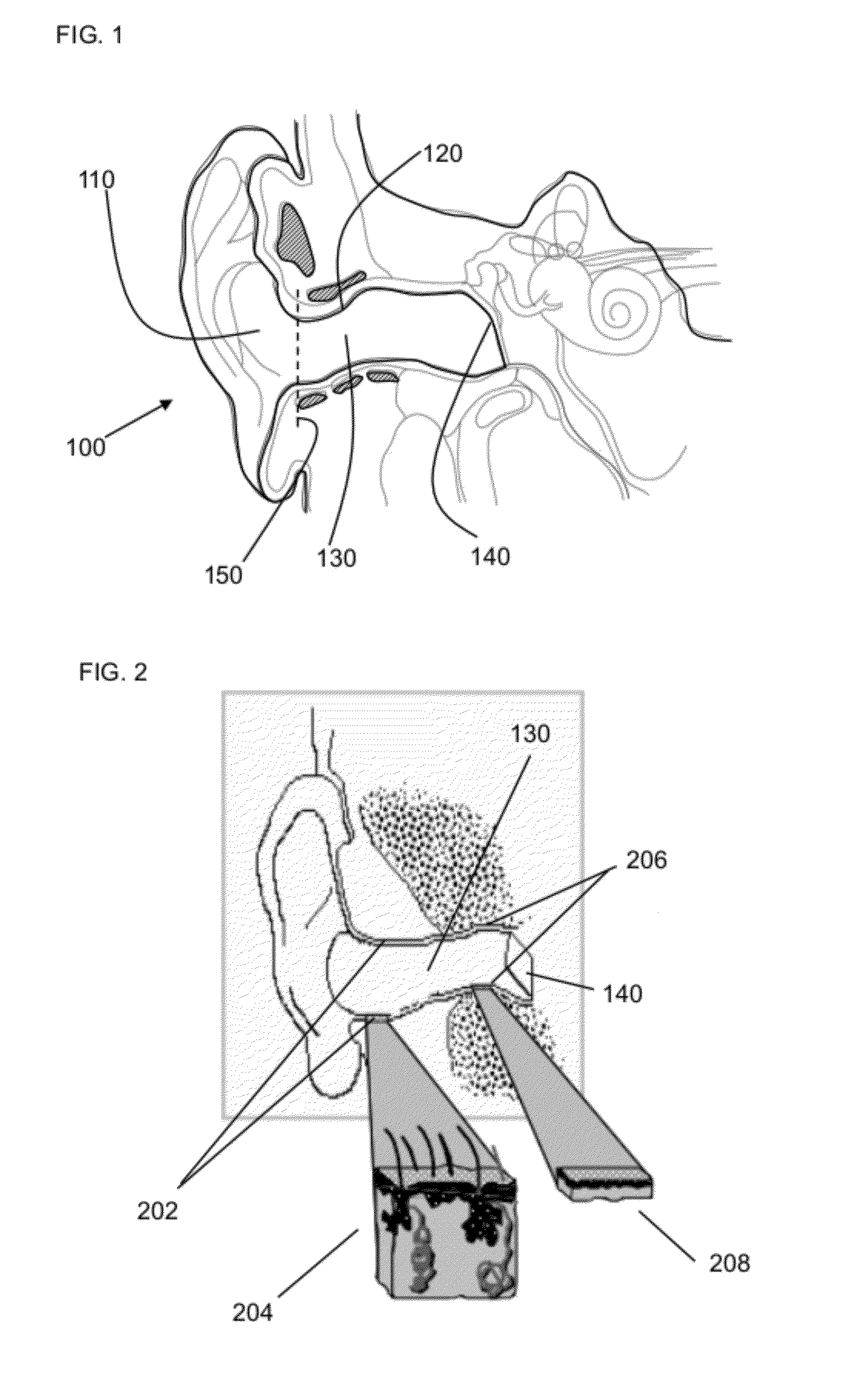 Method and device for acoustic sealing