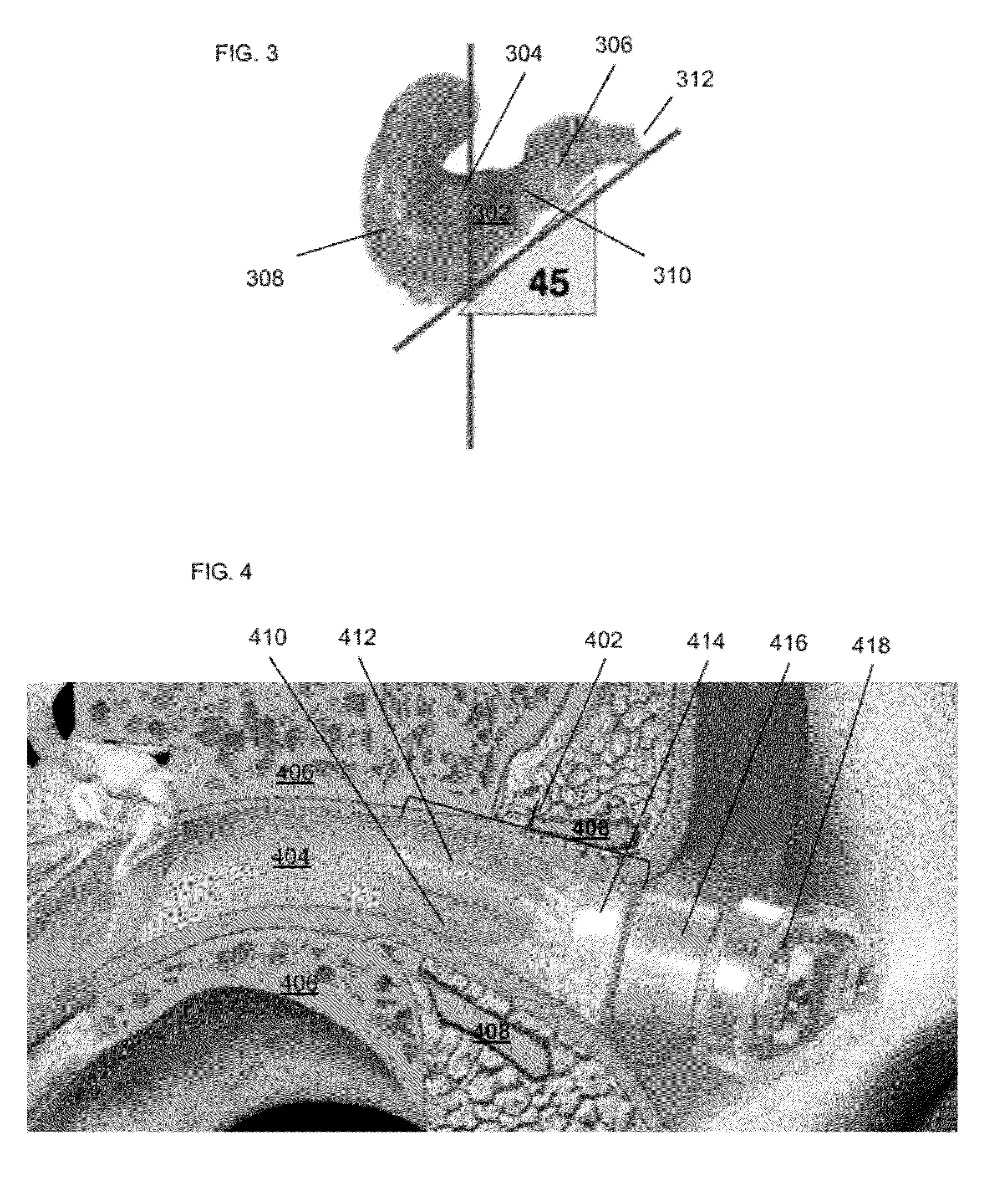 Method and device for acoustic sealing