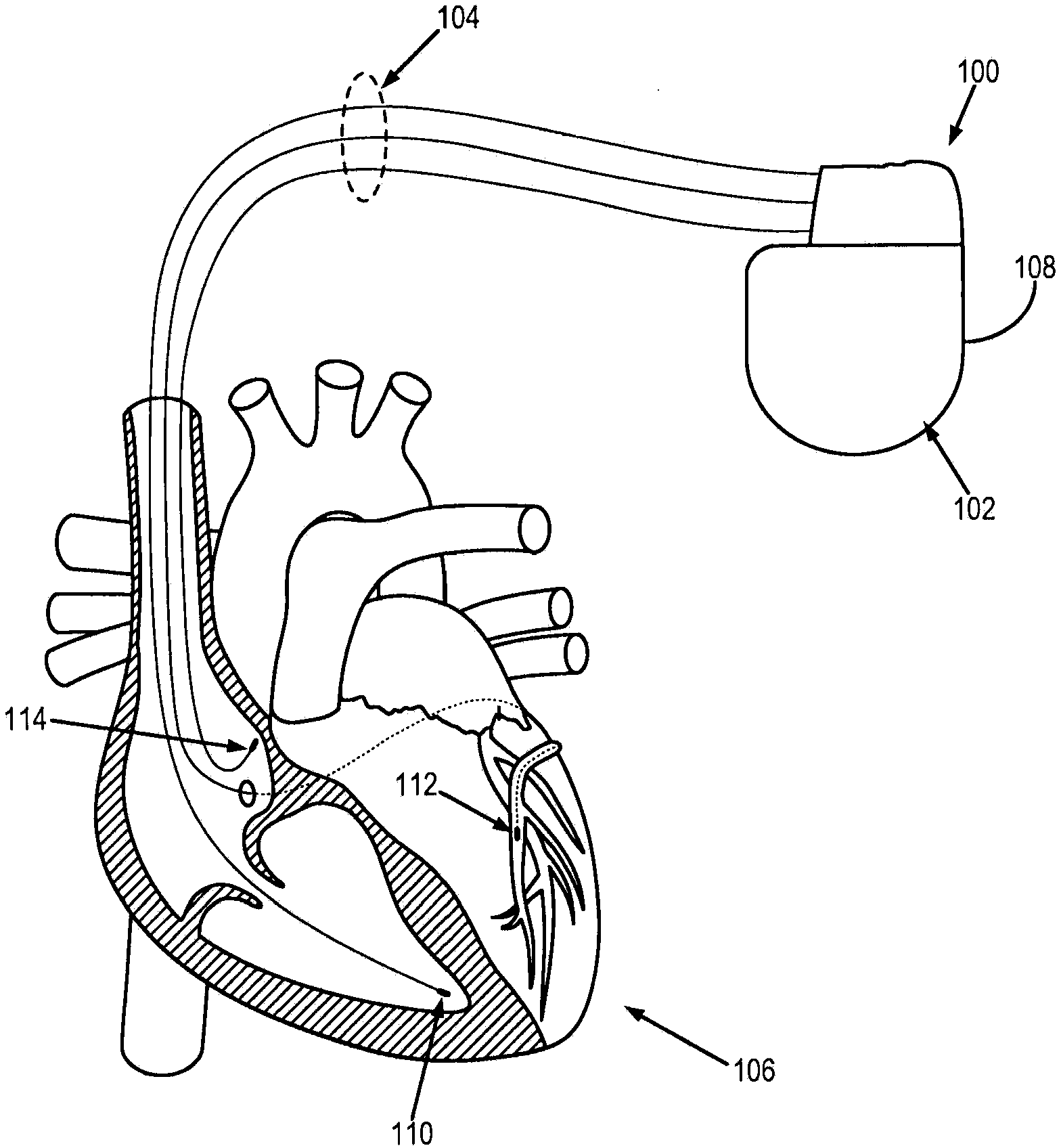 System and method for cardiac resychronization therapy control parameter generation using ventricular activation simulation and surface ECG registration