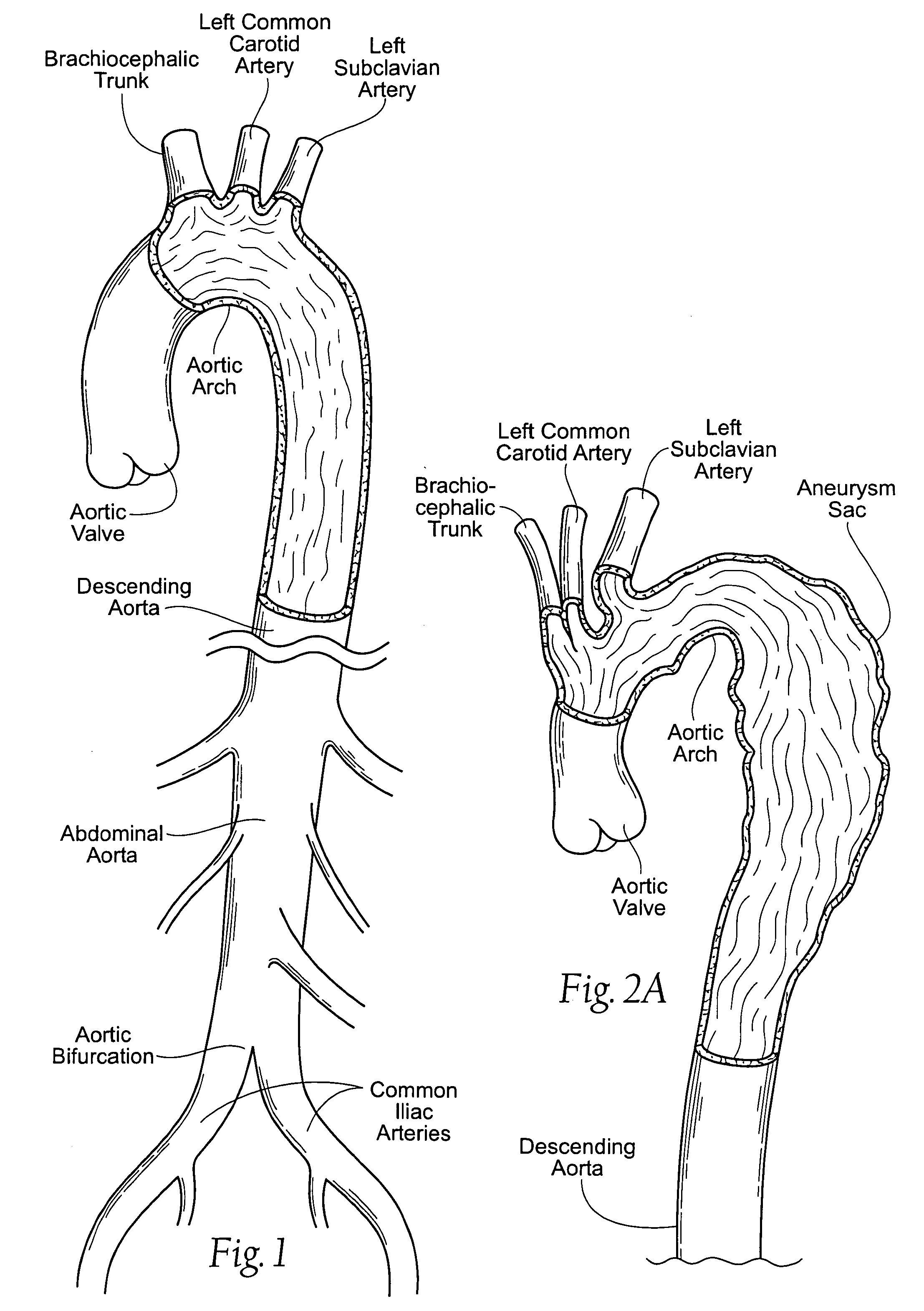 Devices, systems, and methods for endovascular staple and/or prosthesis delivery and implantation