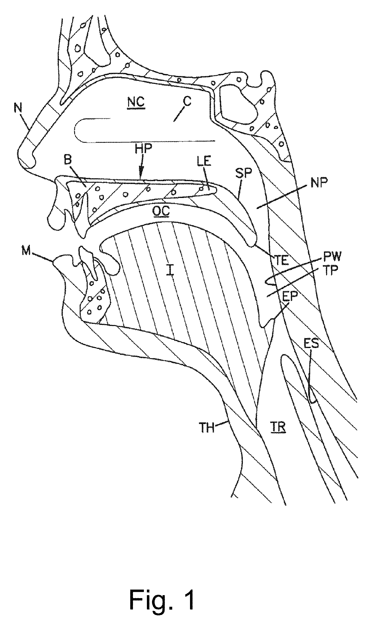 Airway implant delivery device