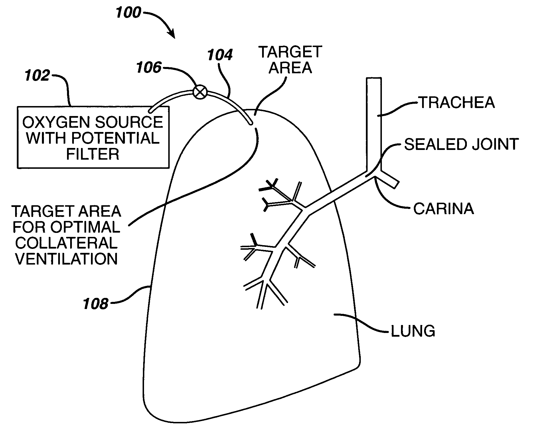 Collateral ventilation device with chest tube/evacuation features