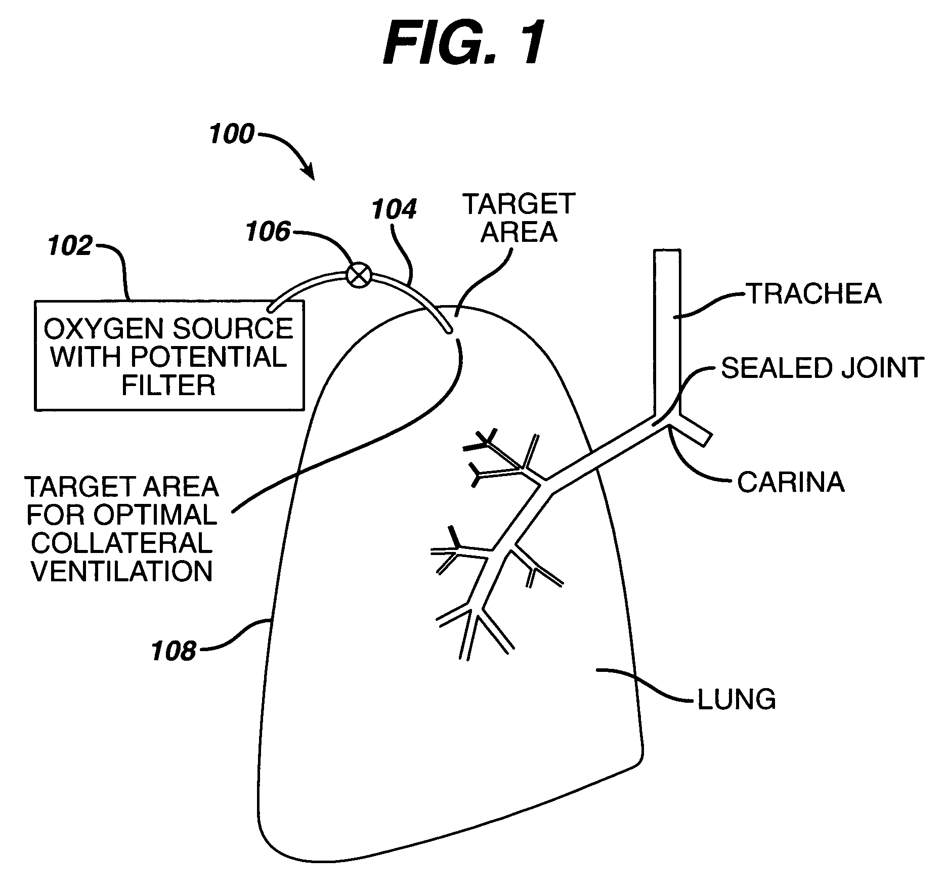 Collateral ventilation device with chest tube/evacuation features