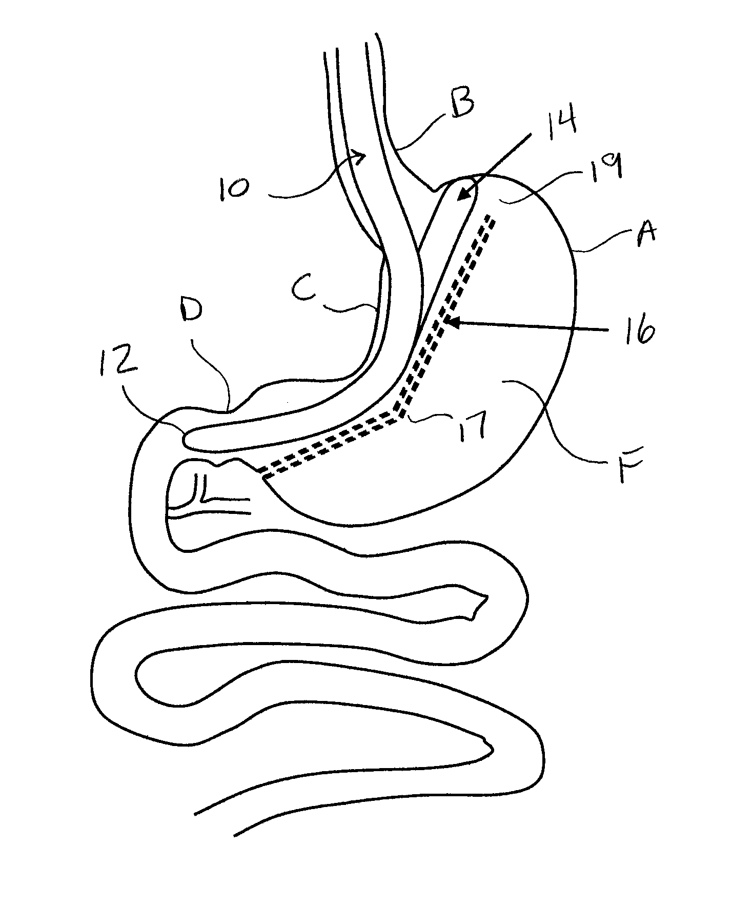 Methods and devices for performing gastroplasty