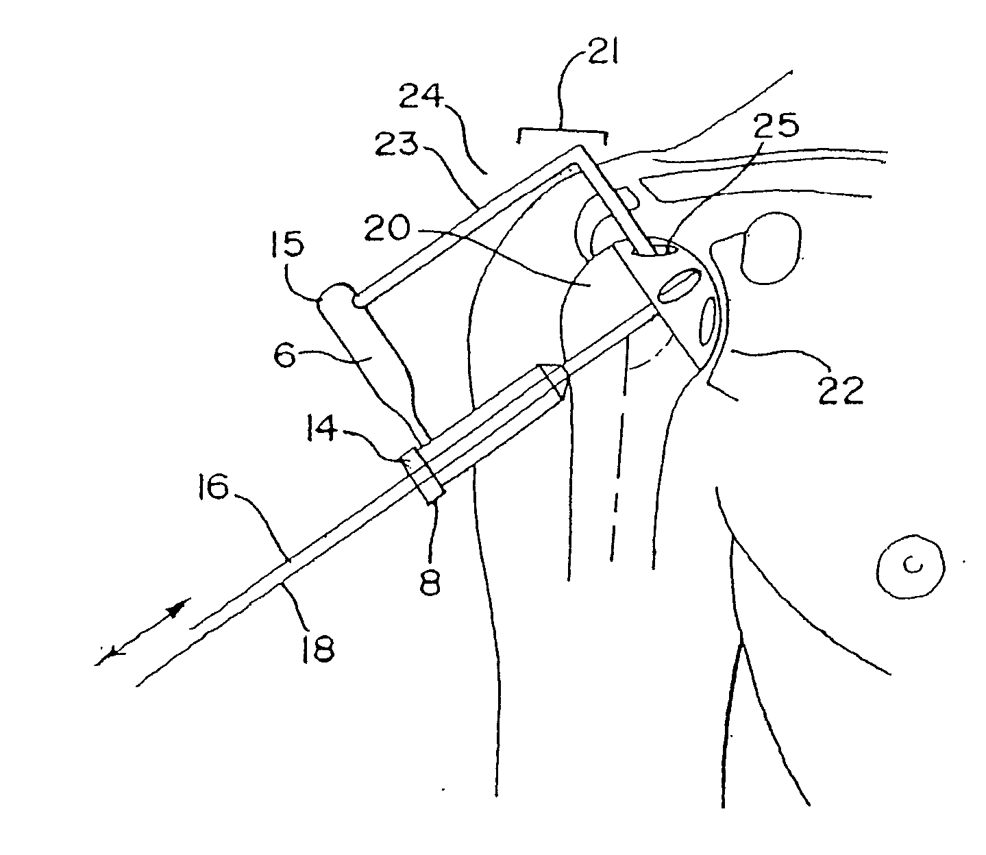 Method of minimally invasive shoulder replacement surgery