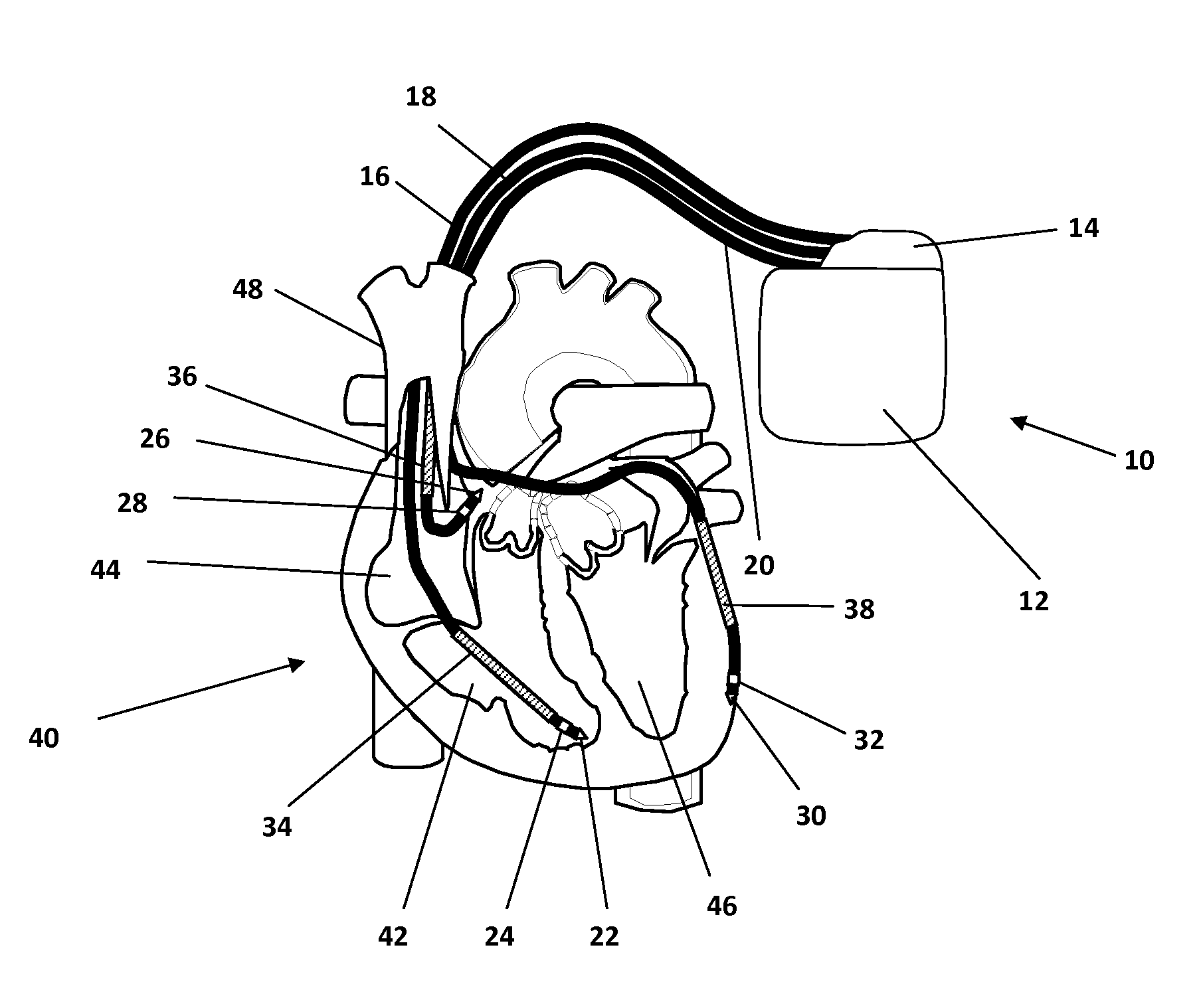 Device and method for fusion beat detection