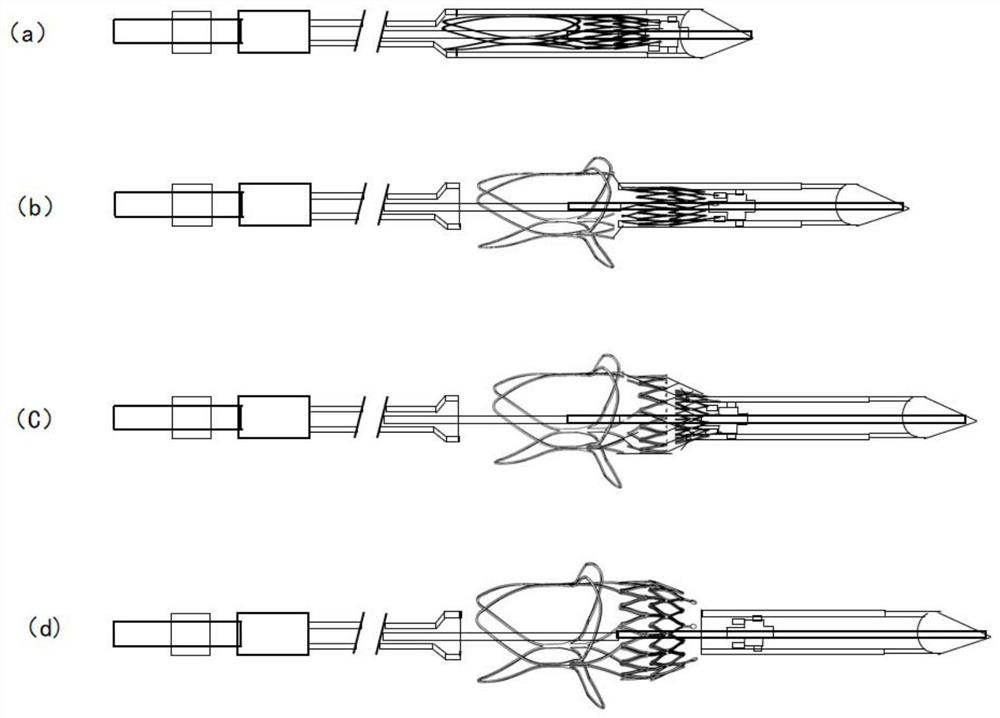 Valve stent applied to aortic valve regurgitation