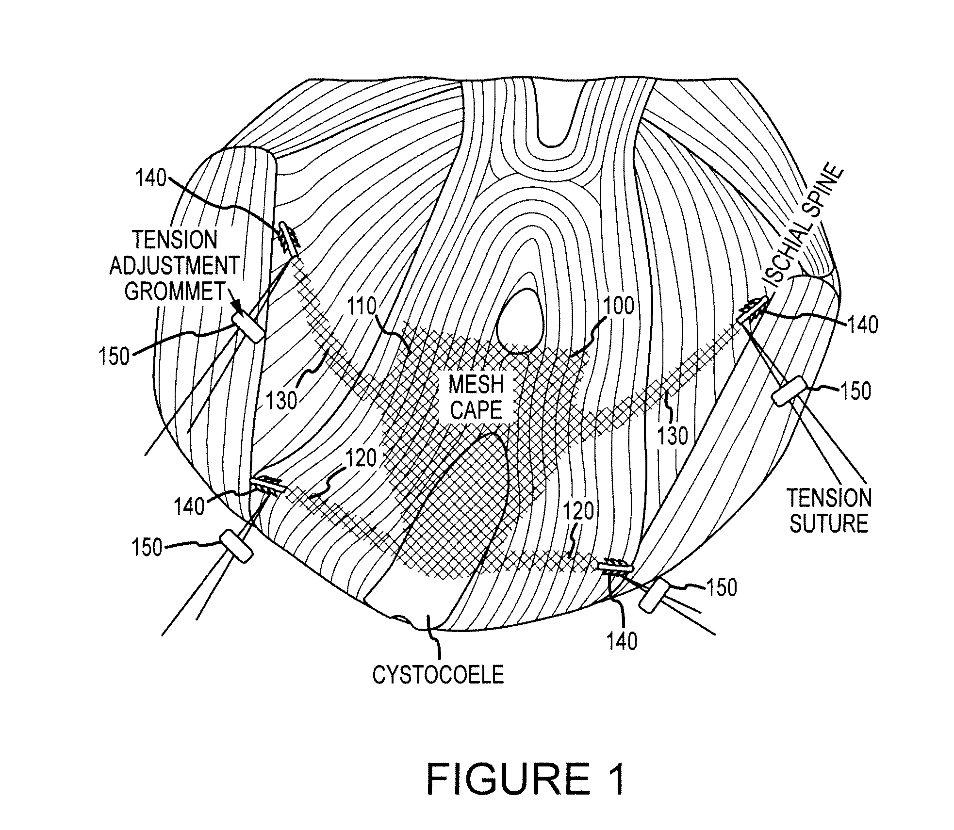 Systems and methods for treating anterior pelvic organ prolapse