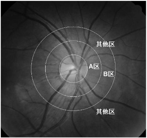 Method and system for analyzing hypertension retinal vessel change characteristic data