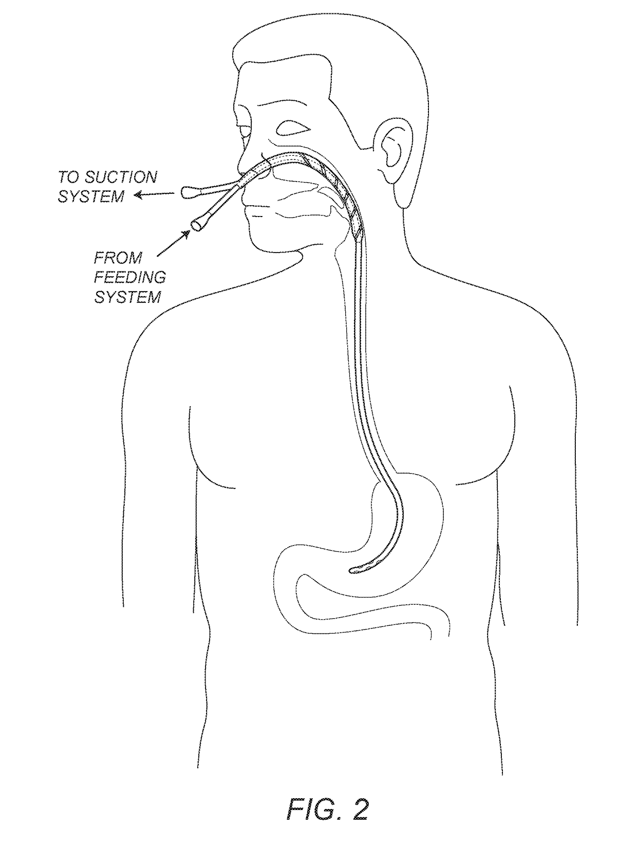 Pharyngeal-enteric tube combination