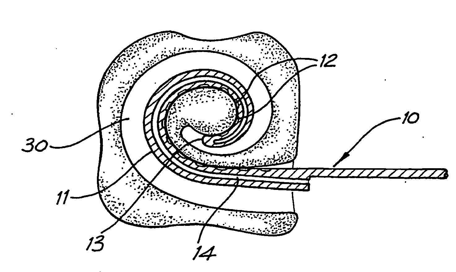 Cochlear implant electrode array