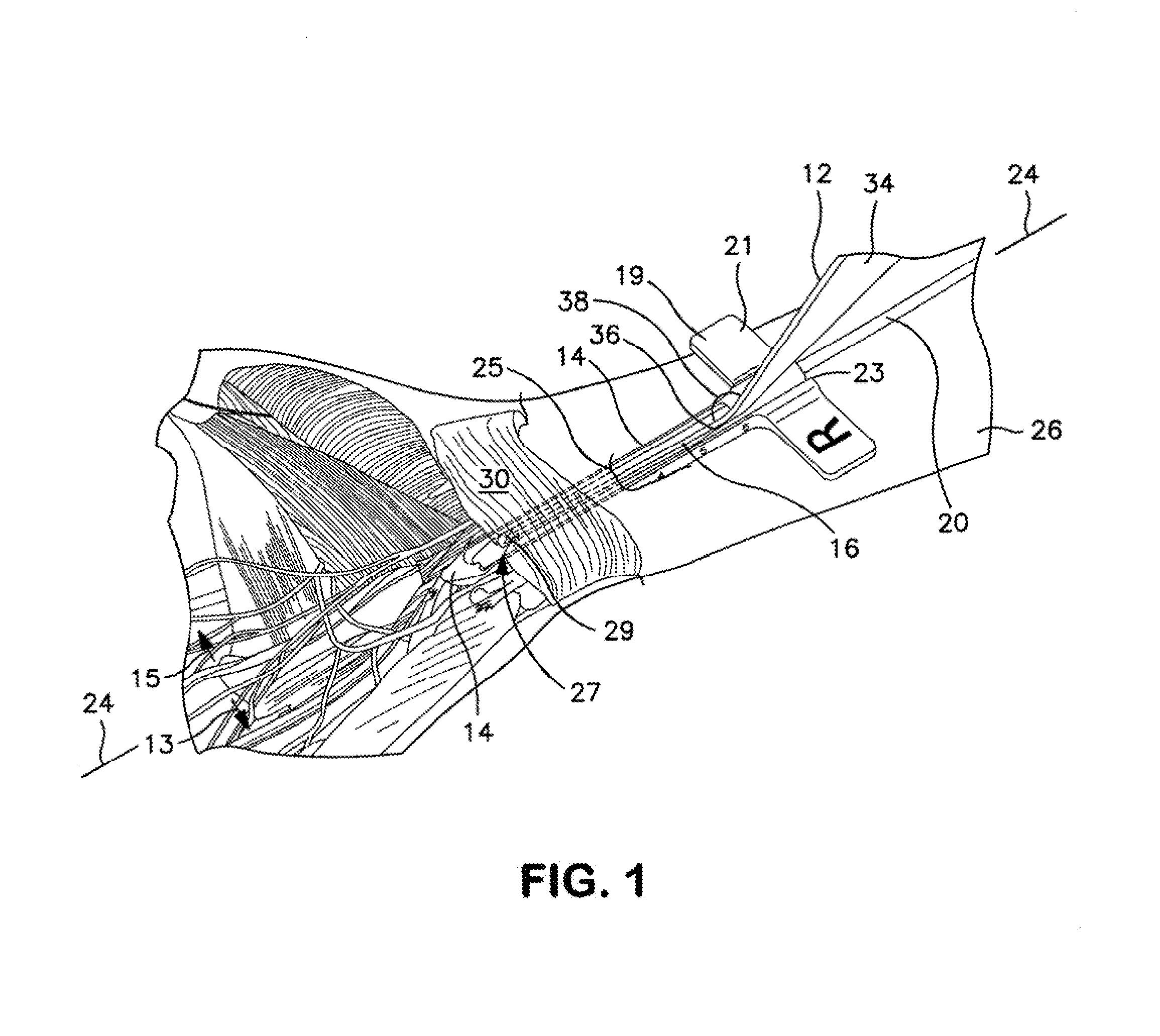 Method and Apparatus for Endoscopic Ligament Release