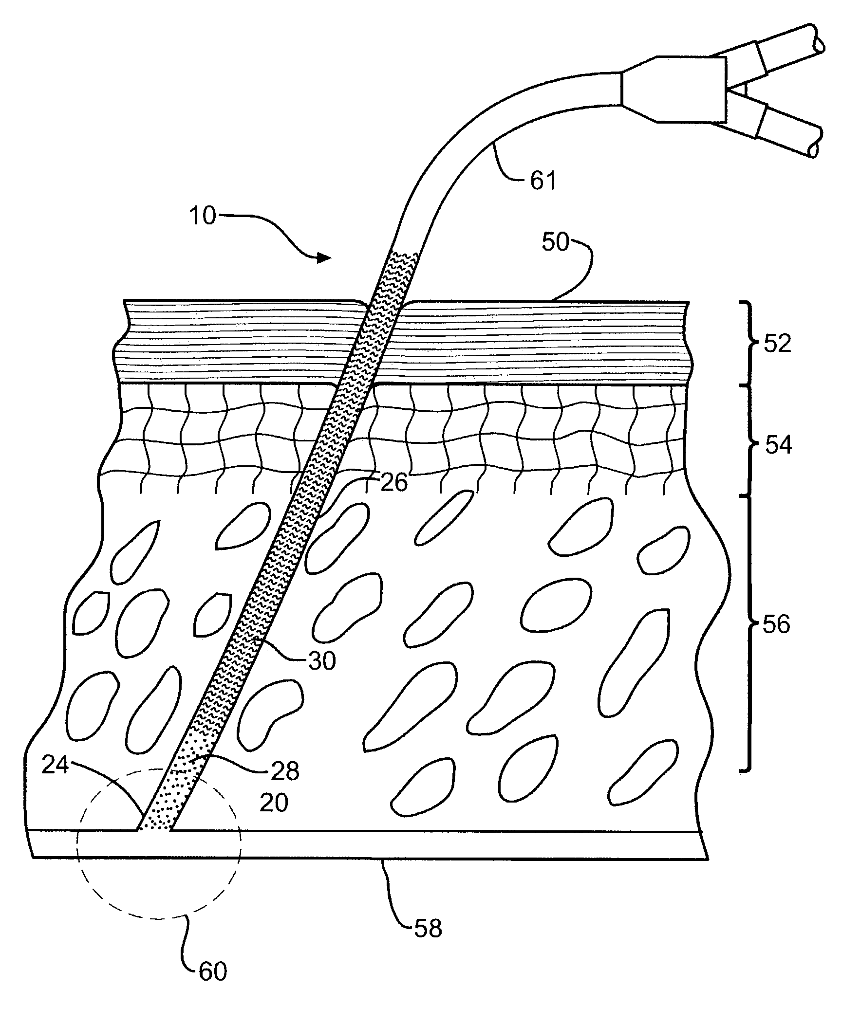 Medical device with therapeutic agents