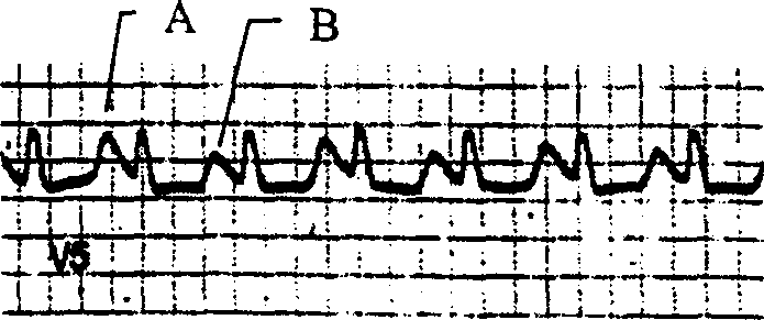 Alternating T-wave measuring method and device for sports electrocardiogram