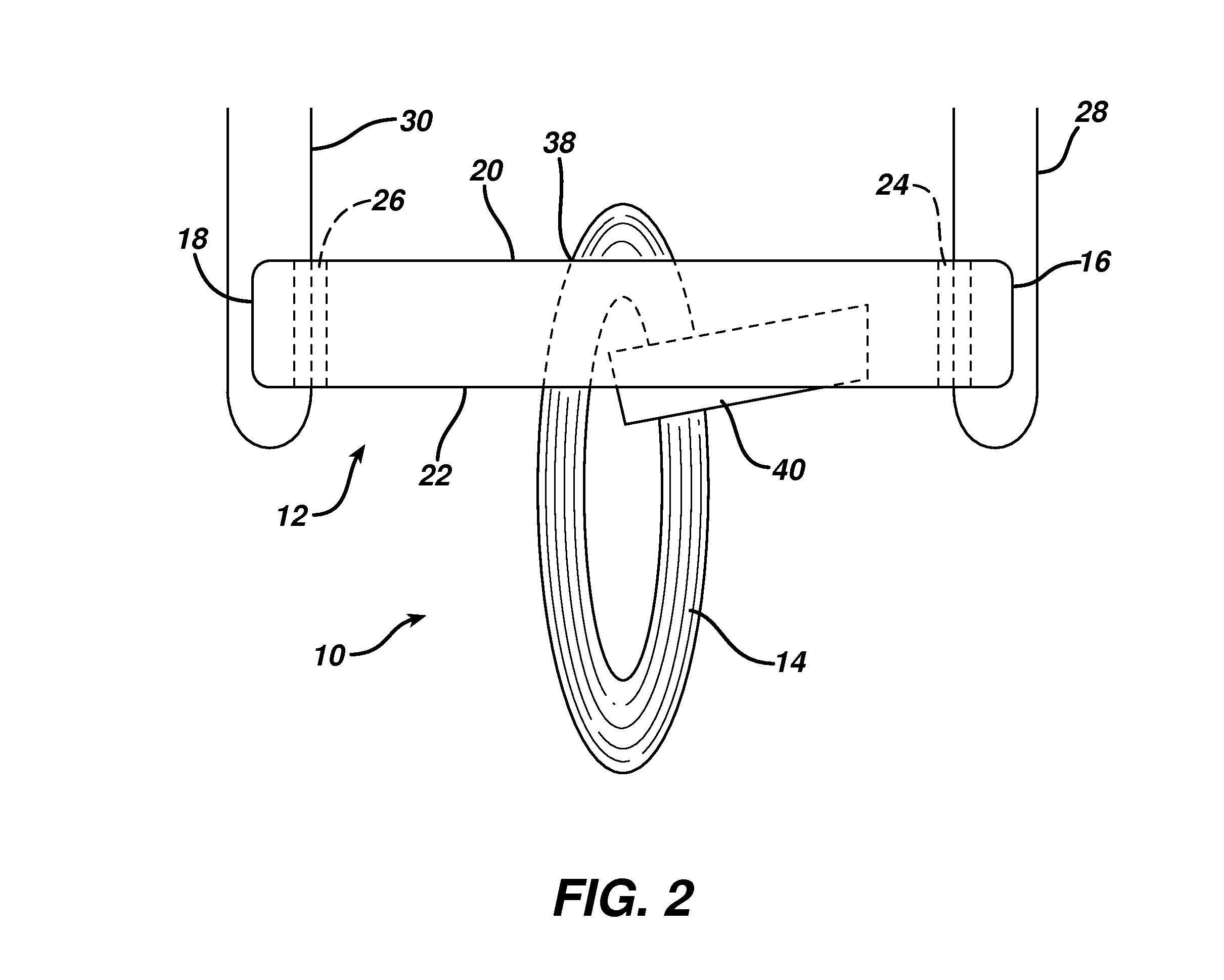 Flipping-type graft fixation device and method