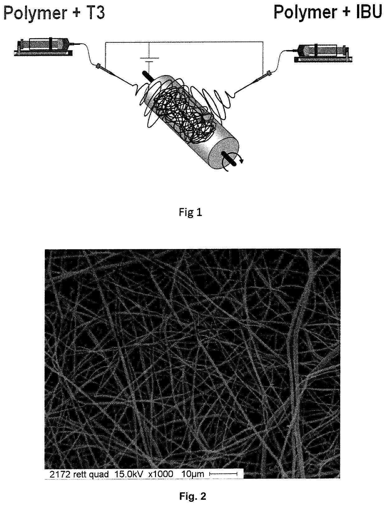 Electrospun fibers for a local release of an Anti-inflammatory drug and a promyelinating drug