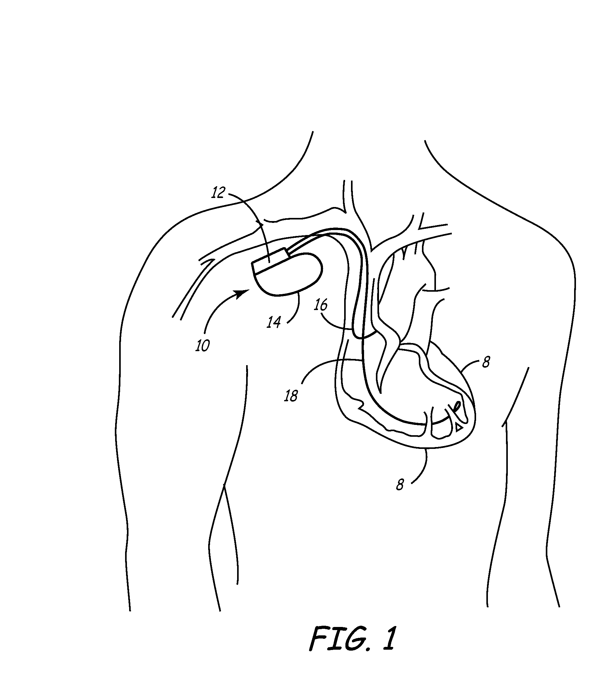 Synchronized atrial anti-tachy pacing system and method