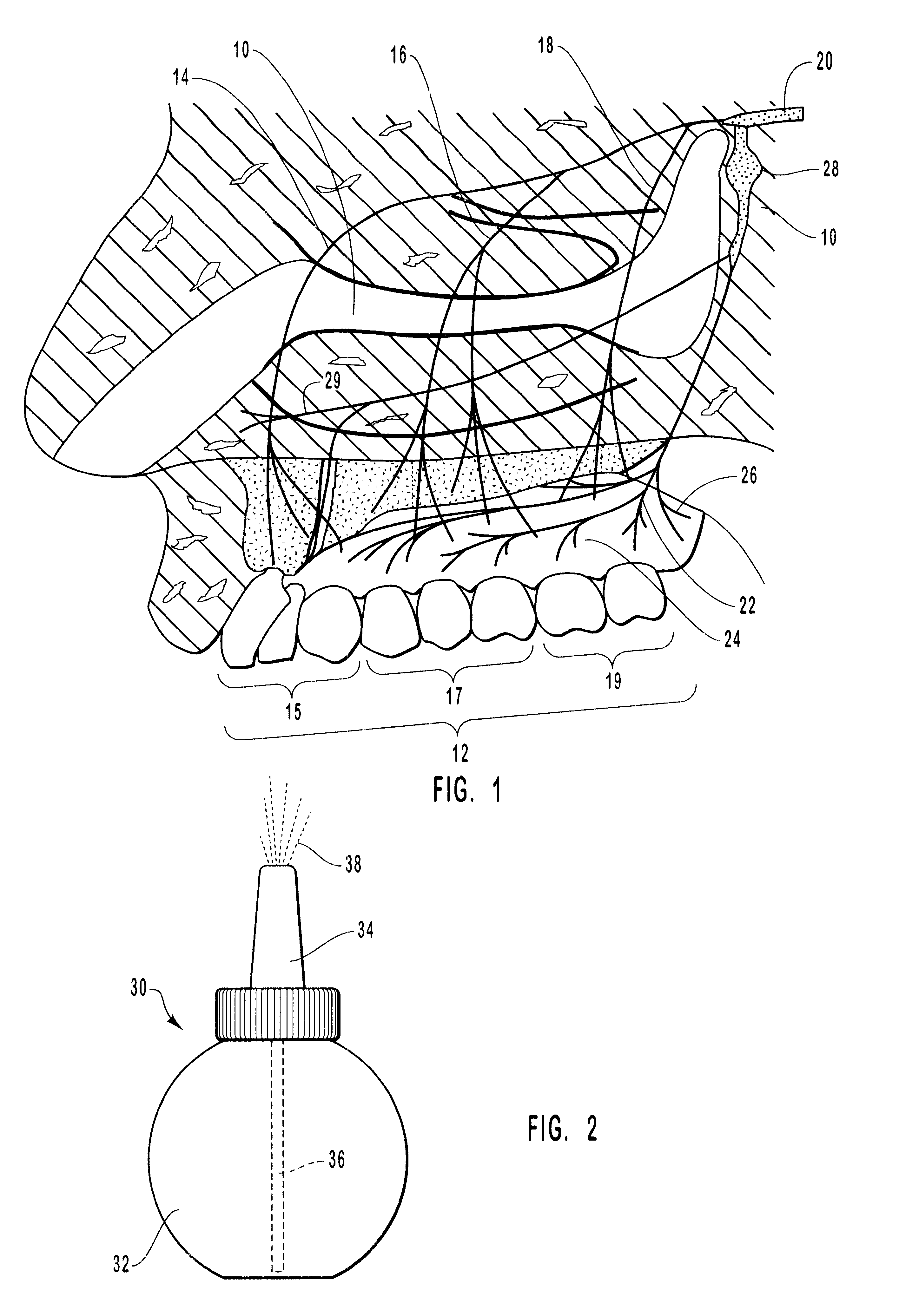 Methods and kits for maxillary dental anesthesia by means of a nasal deliverable anesthetic