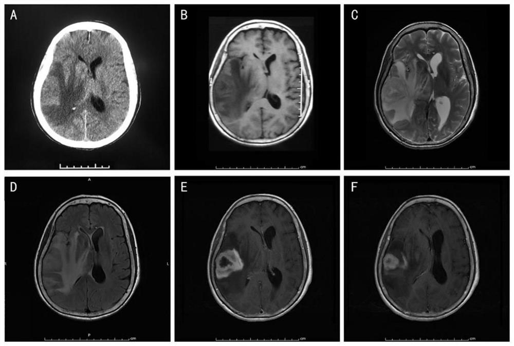 Human glioblastoma cell line GWH04 as well as culture method and application thereof