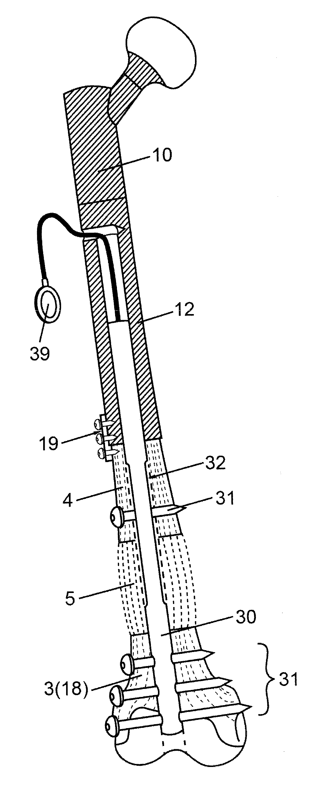 Implantable prosthesis for replacing a human hip or knee joint and the adjoining bone sections