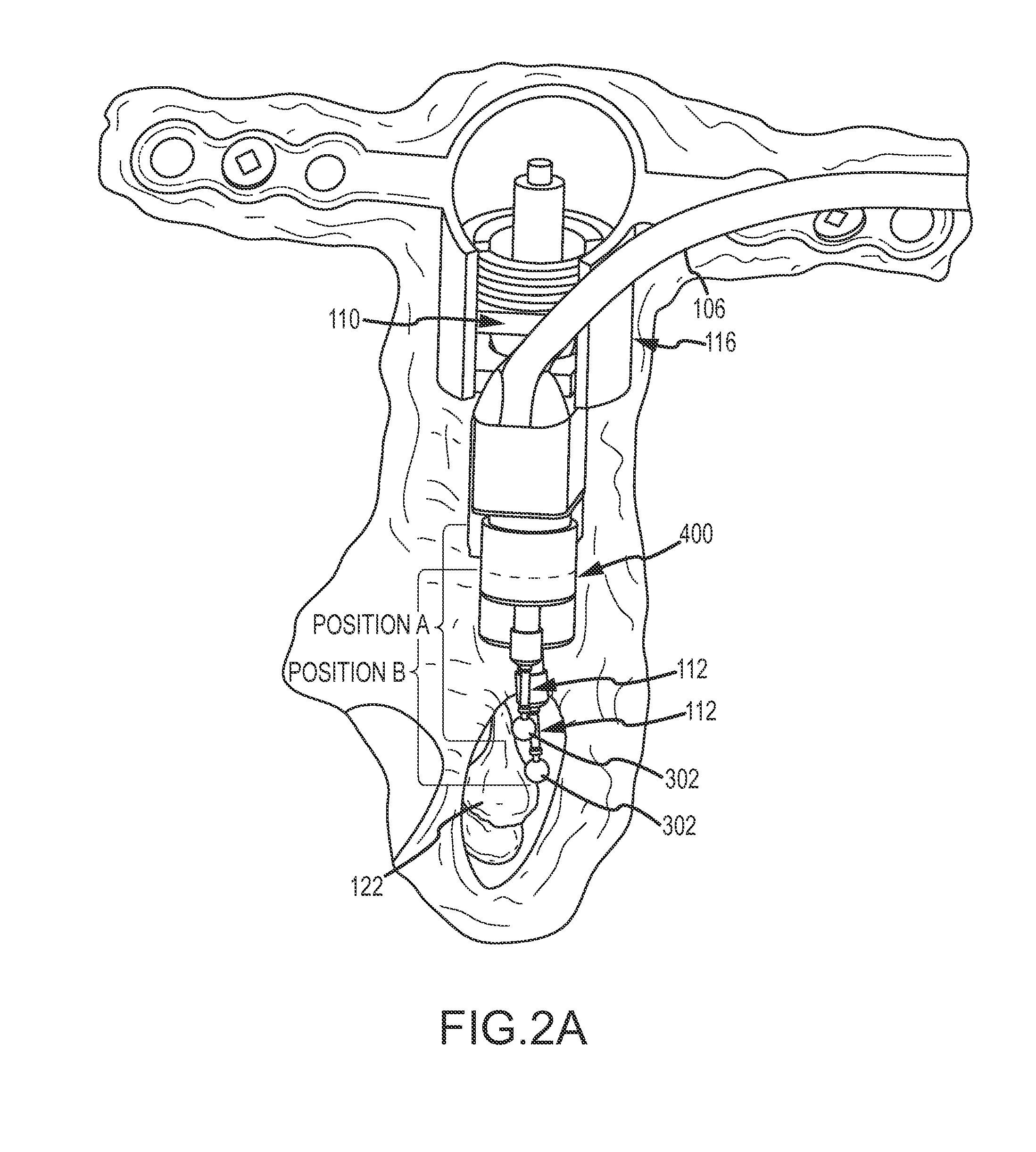 Lateral coupling of an implantable hearing aid actuator to an auditory component