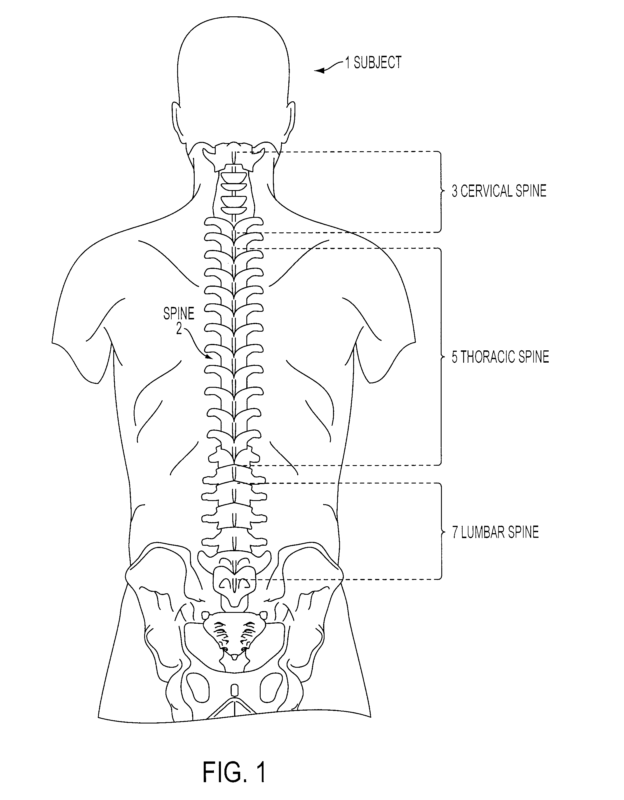 Expandable Intervertebral Prosthesis Device for Posterior Implantation and Related Method Thereof