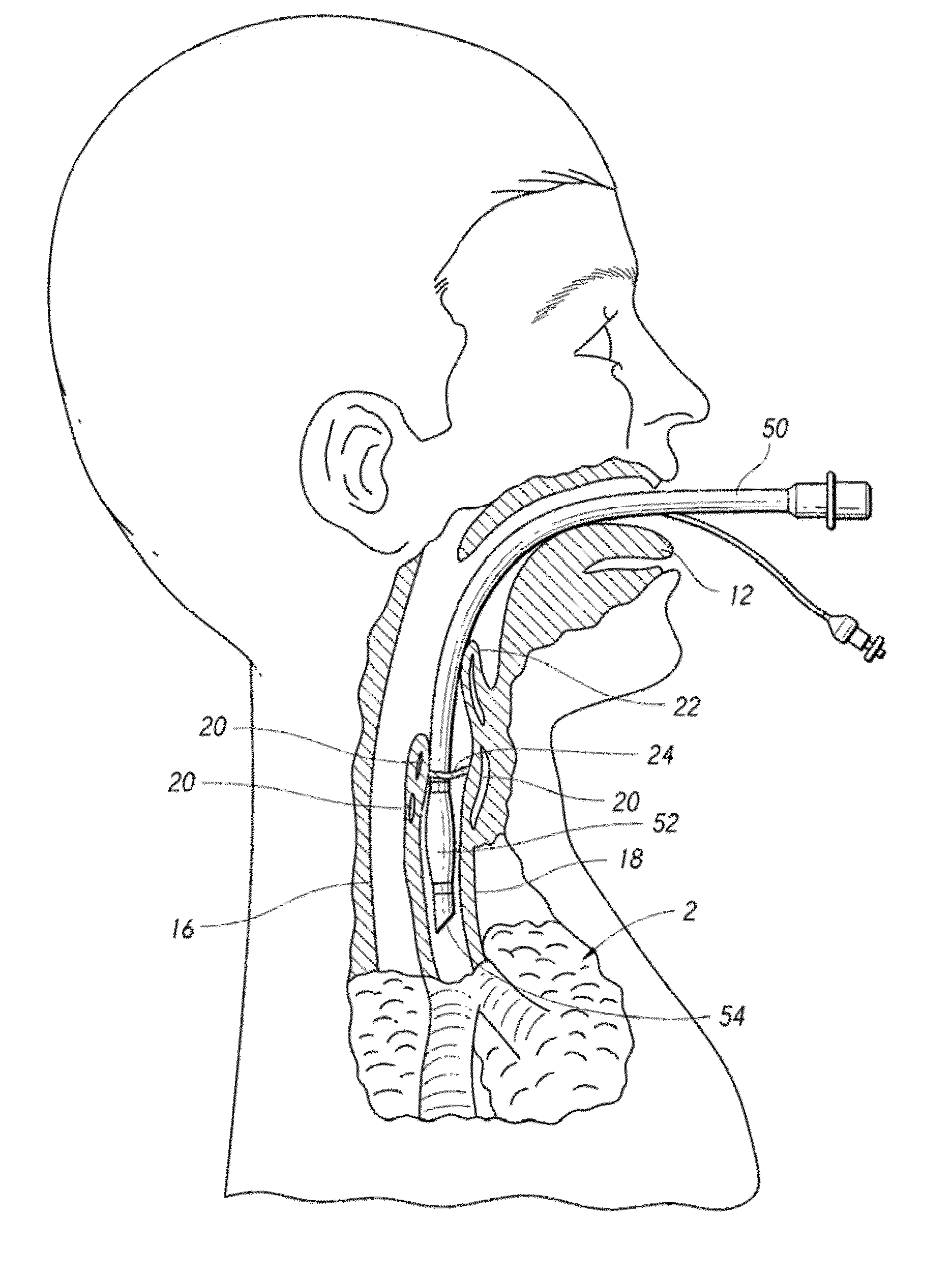 Apparatus and method for improved assisted ventilation