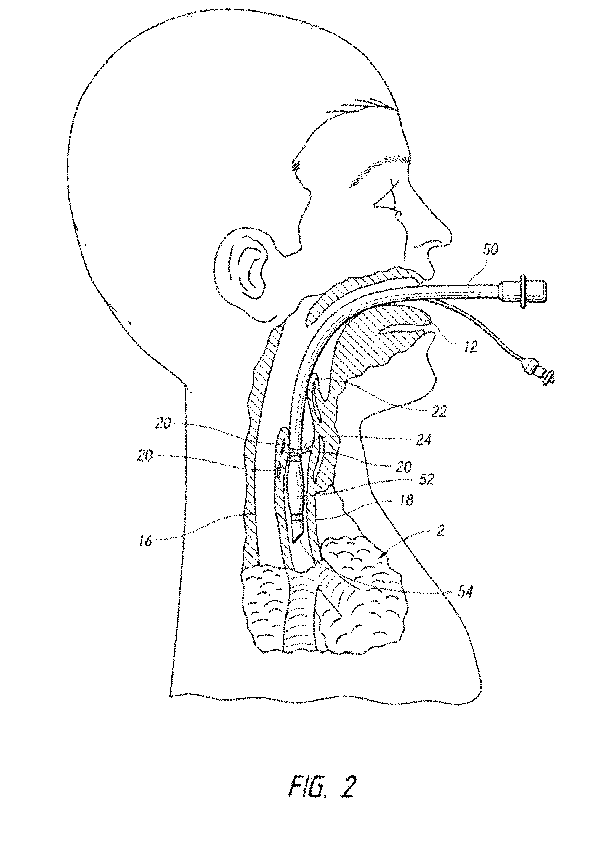 Apparatus and method for improved assisted ventilation
