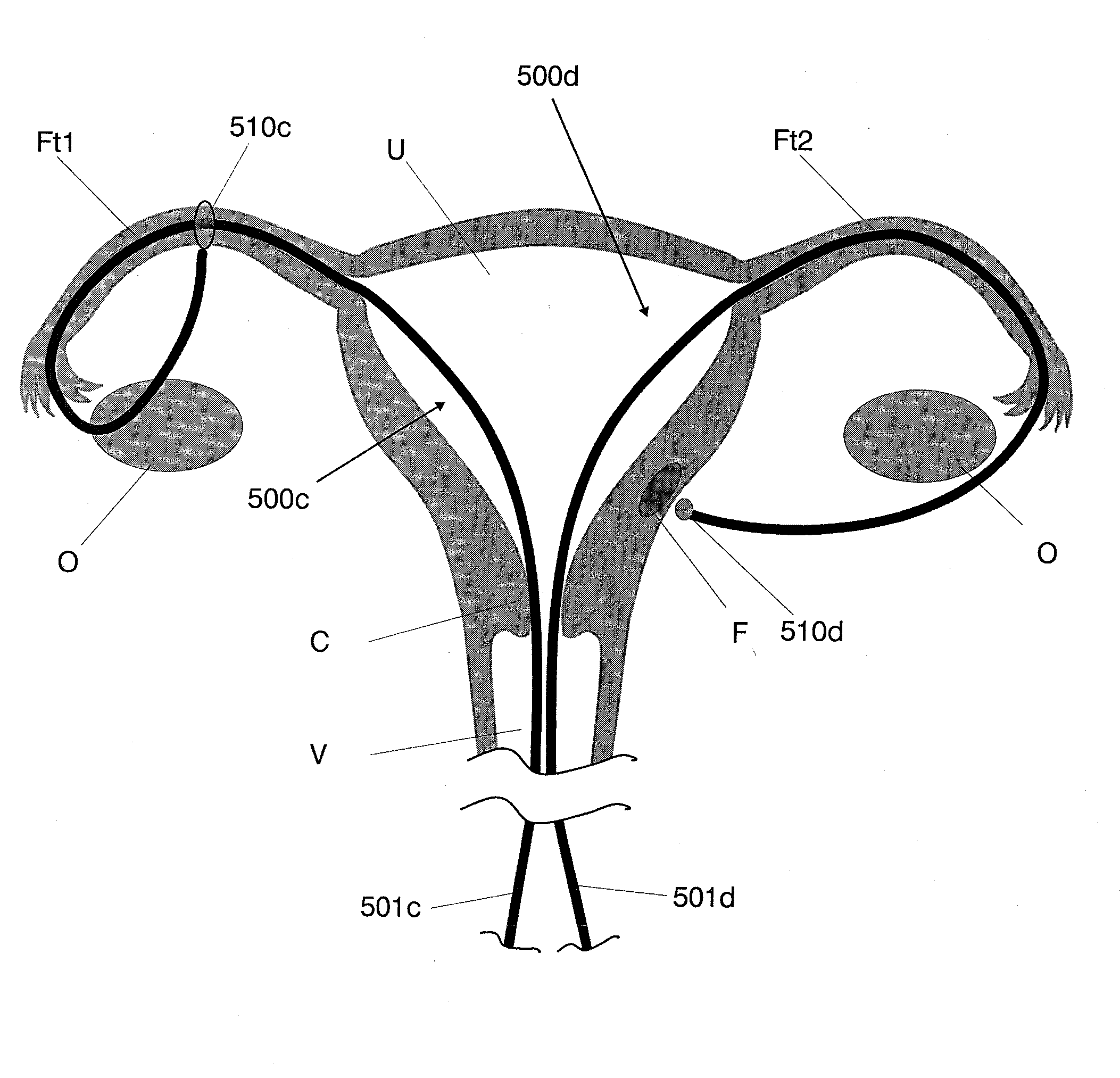 Intrauterine access and procedure system with laterally deflectable sheath