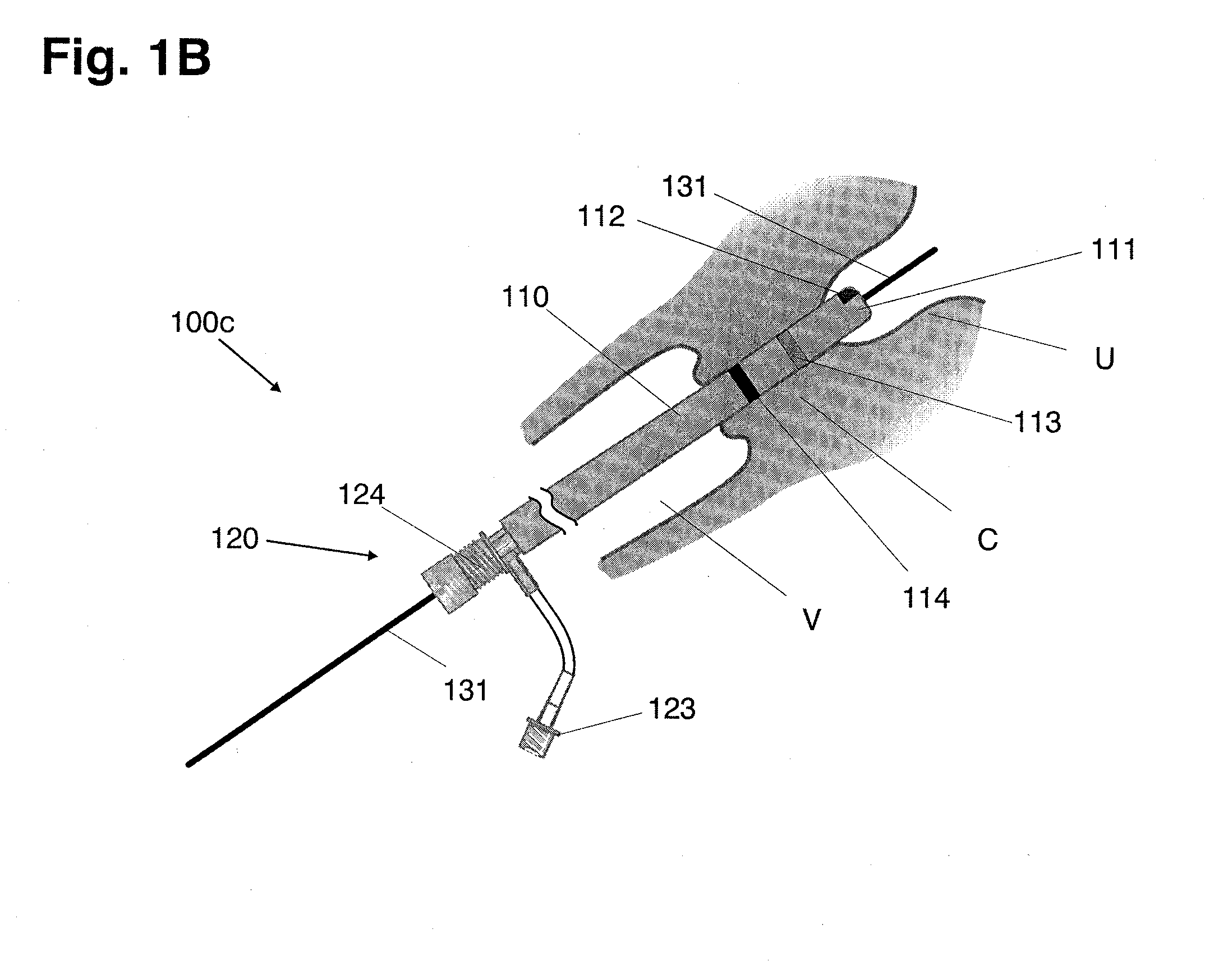 Intrauterine access and procedure system with laterally deflectable sheath