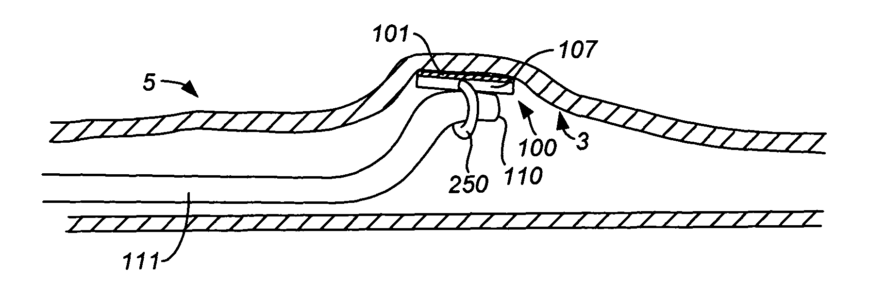 Precision ablating device