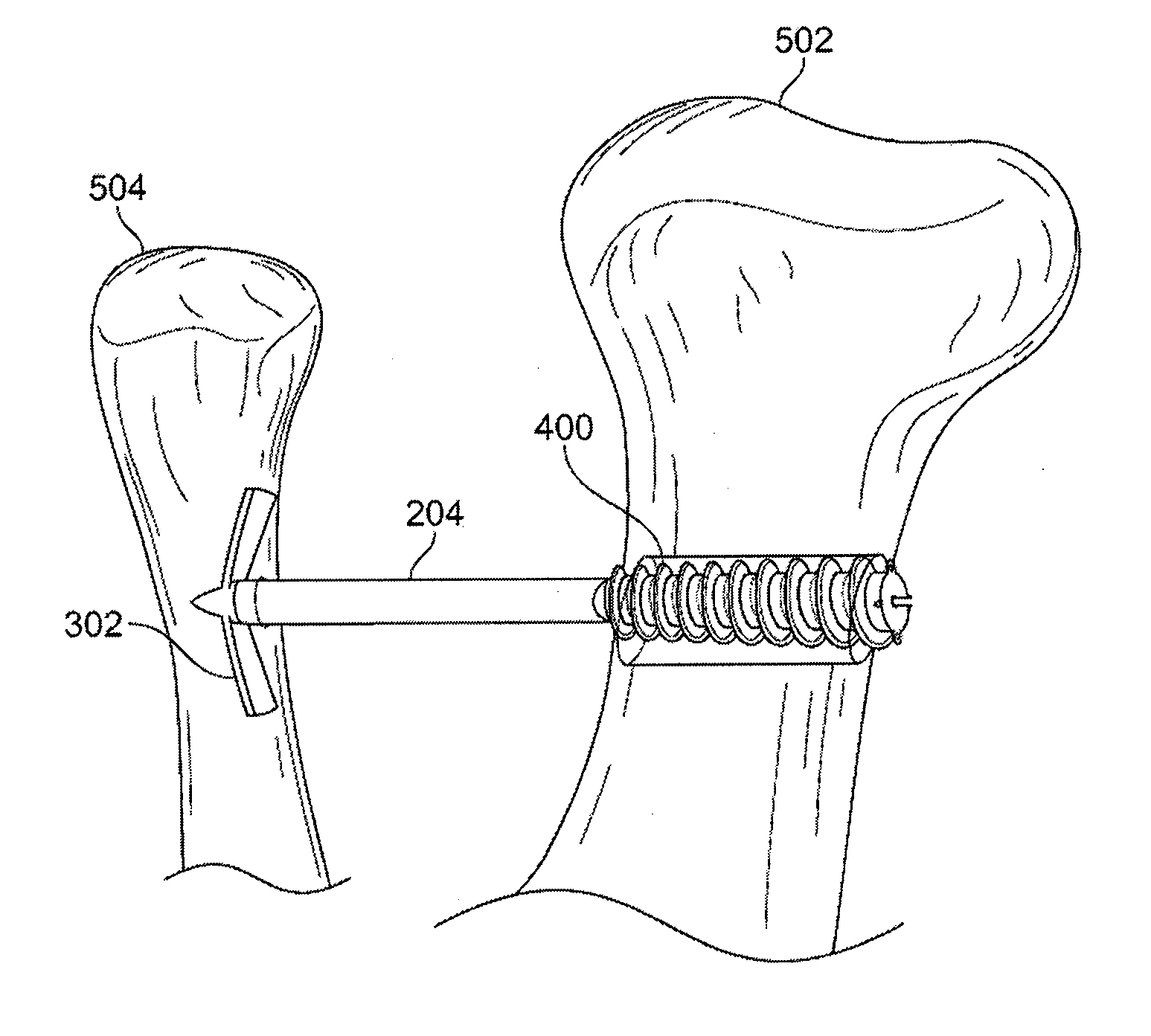 Fixation and alignment device and method used in orthopaedic surgery