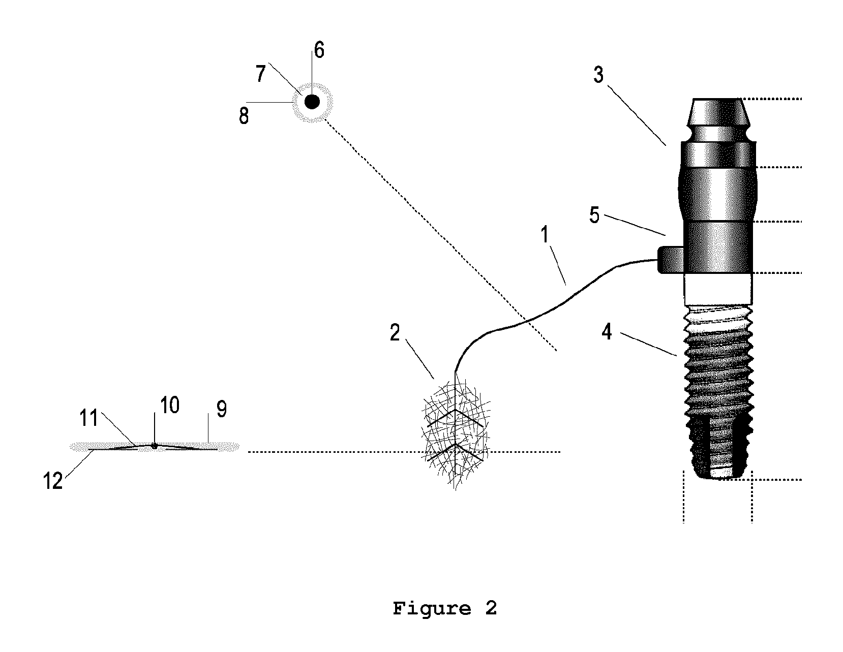 Dental abutment with a force transducer interfacing with a nerve