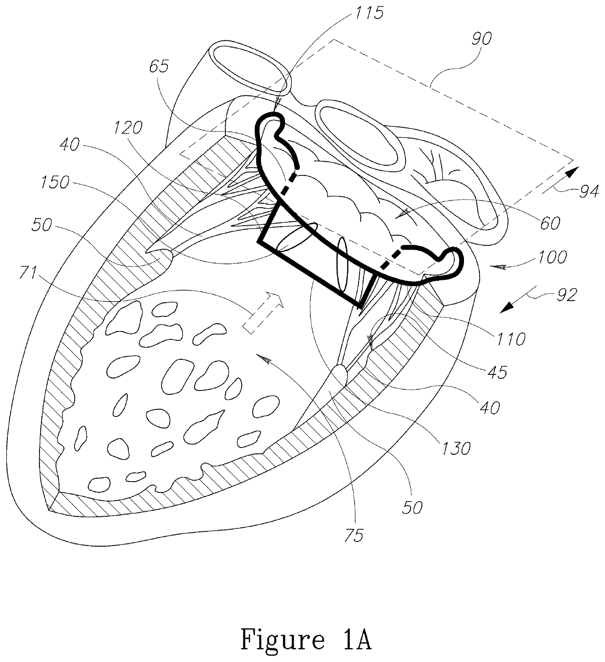 Devices and implantation methods for treating mitral valve condition