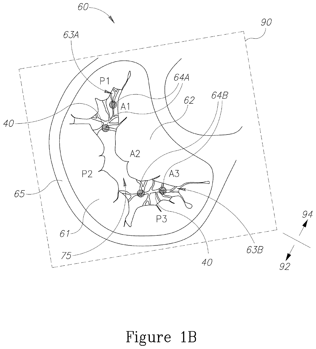 Devices and implantation methods for treating mitral valve condition