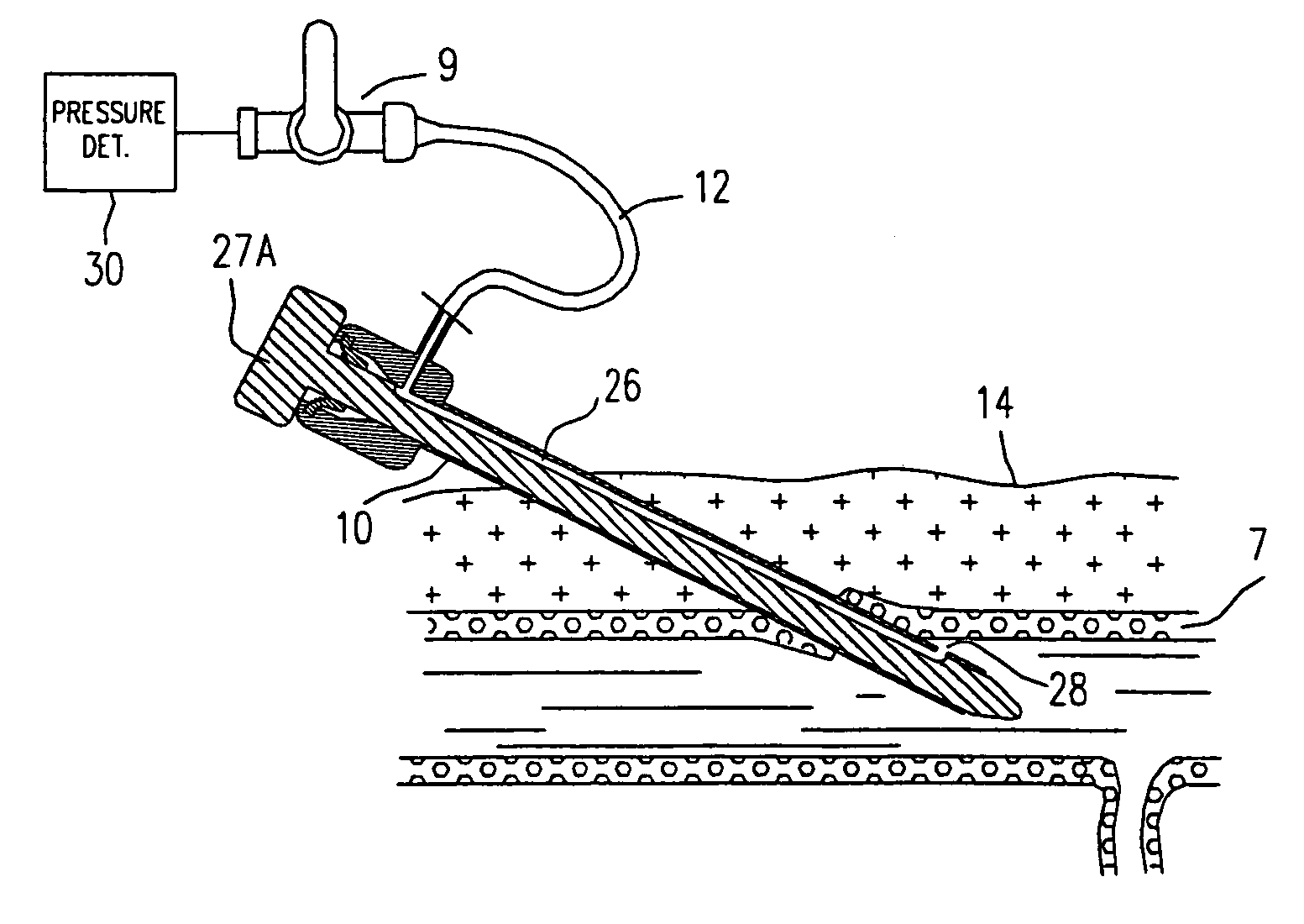 Technique to confirm correct positioning of arterial wall sealing device