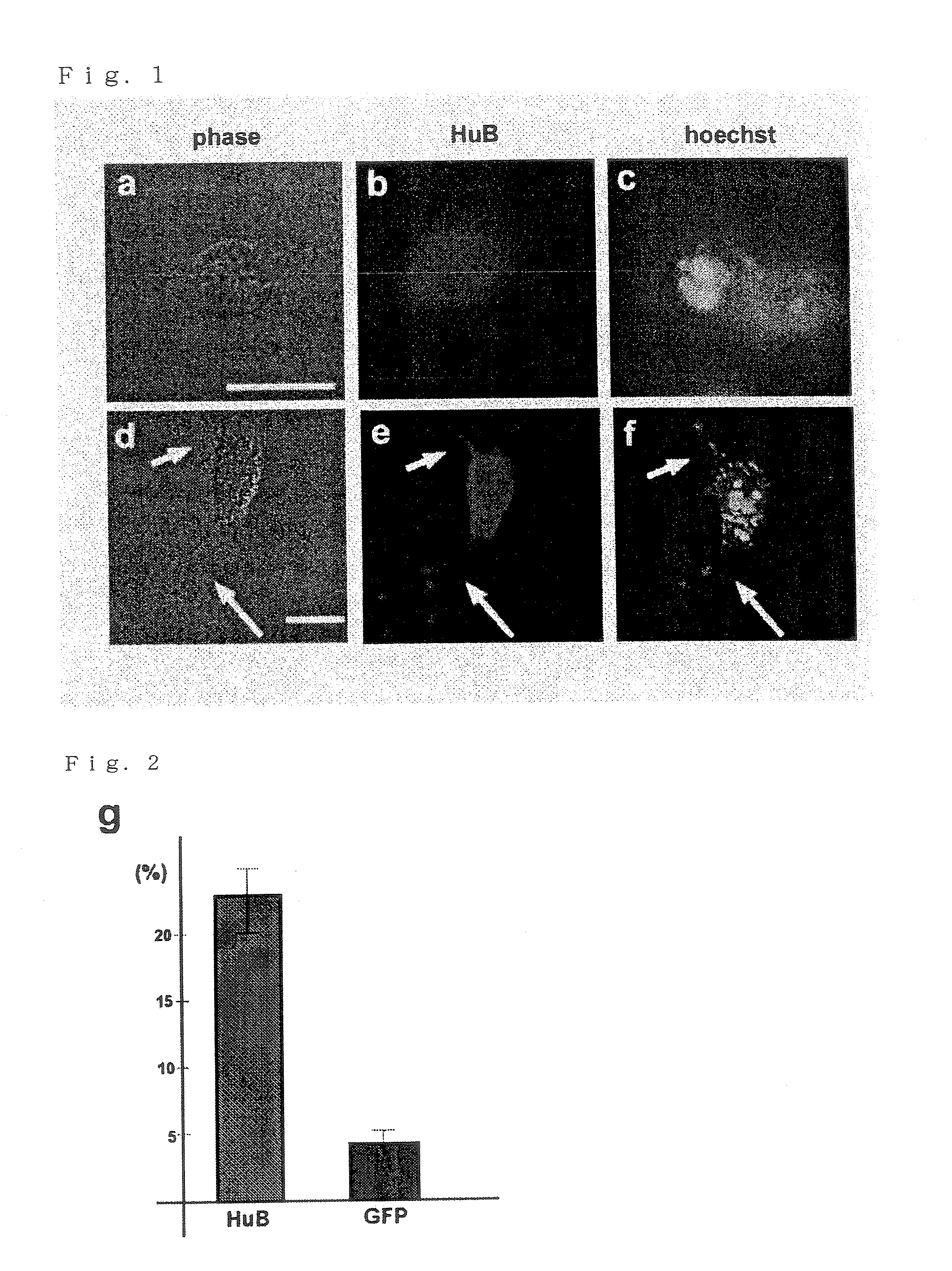 Therapeutic agent for tumor of neural origin