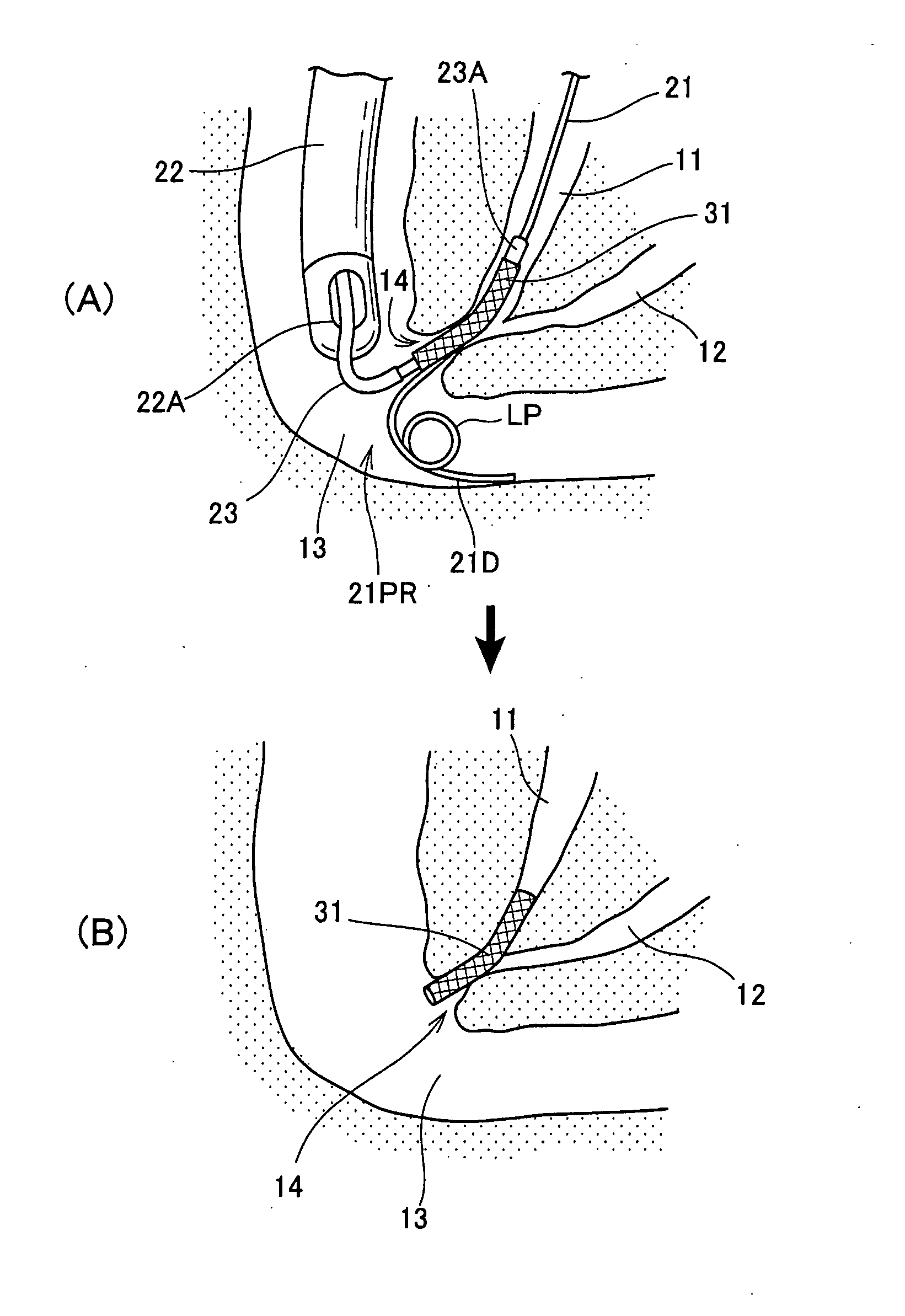 Method for inserting endoscopic device into hollow organ