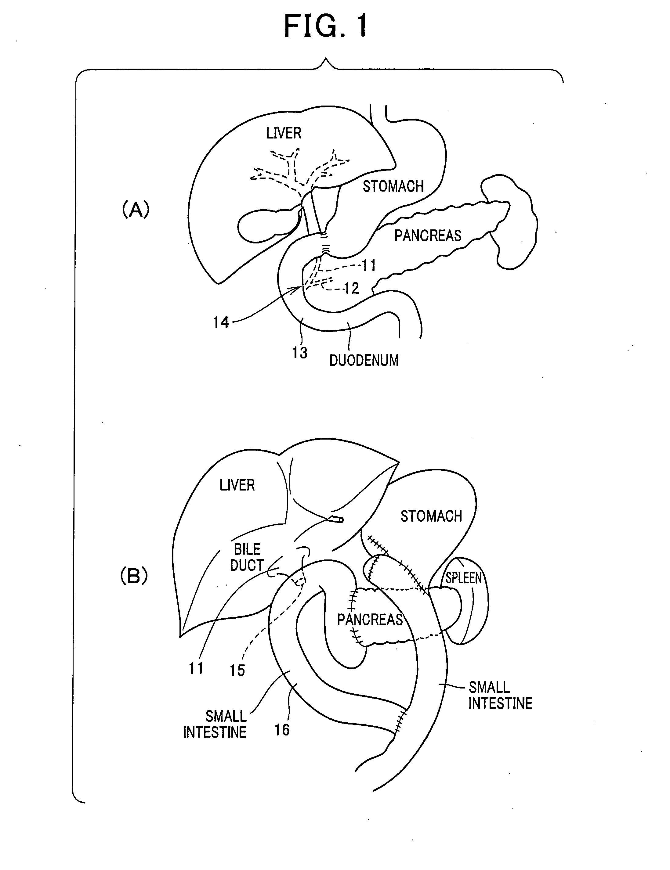 Method for inserting endoscopic device into hollow organ