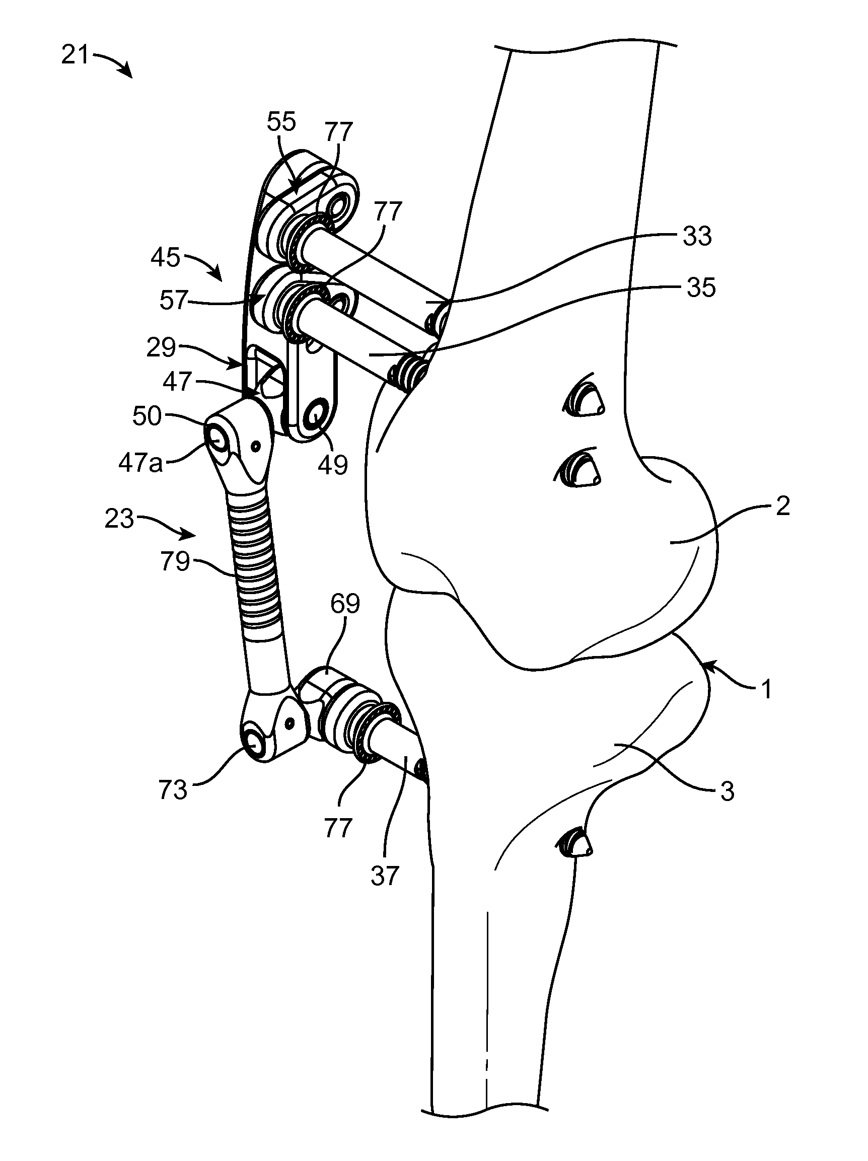 Transcutaneous Joint Unloading Device and Method