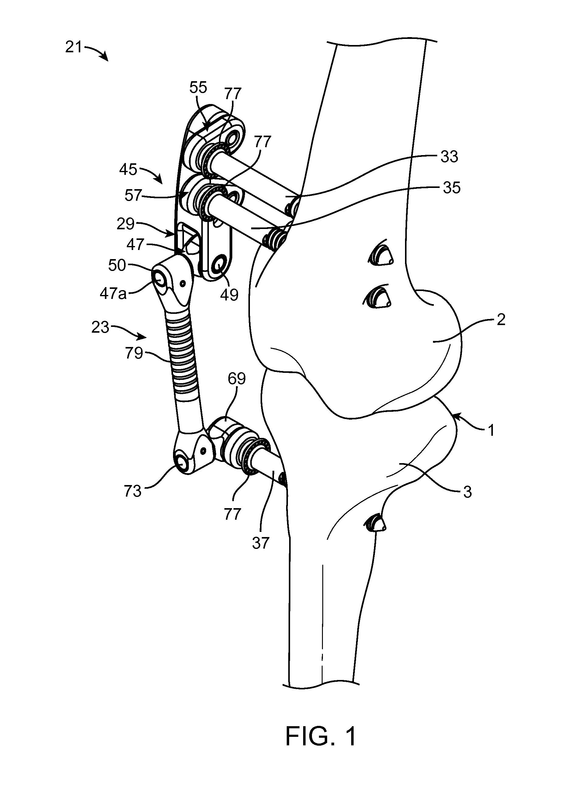 Transcutaneous Joint Unloading Device and Method