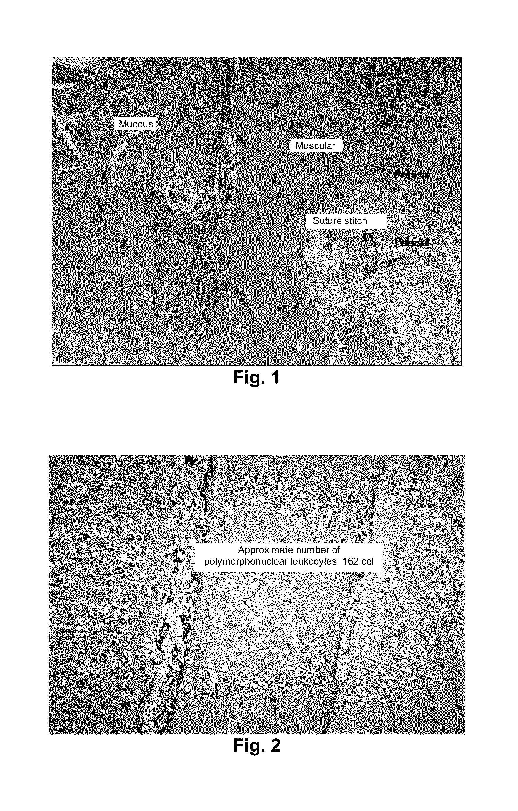 Anti-inflammatory composition for aiding and promoting the healing of chronic ulcerative lesions