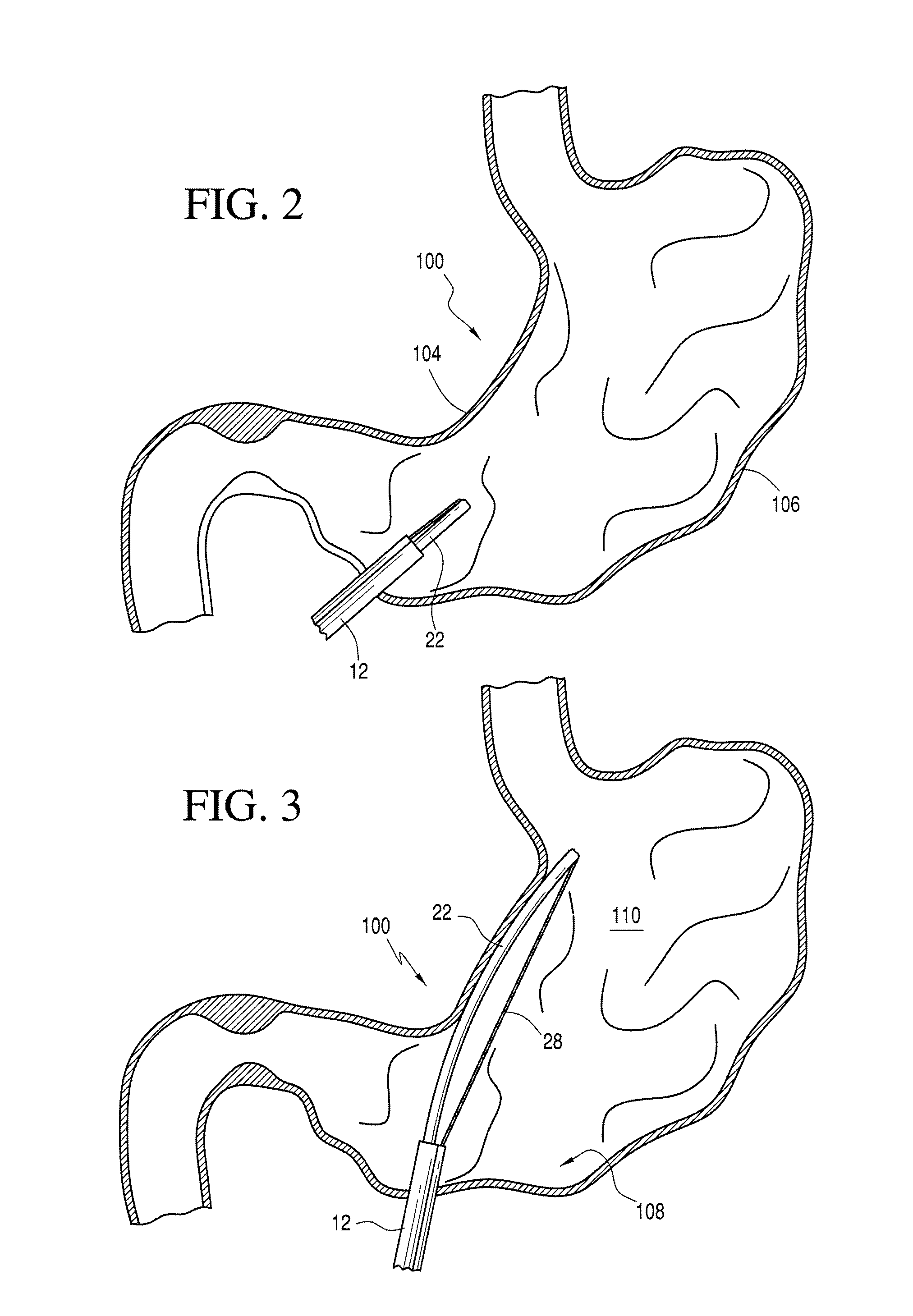 Gastric coil manipulator