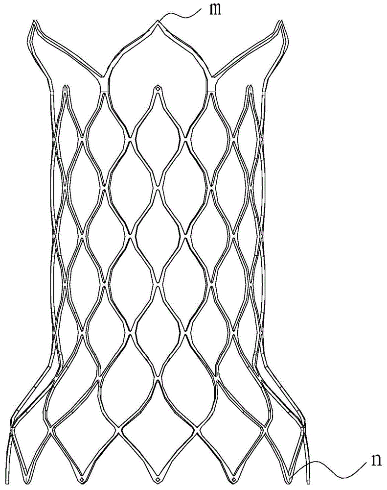 Safety improved pulmonary artery stent and pulmonary artery valve replacement device