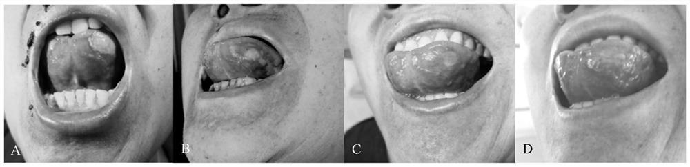 A traditional Chinese medicine composition for treating oral mucosal damage caused by antineoplastic drugs