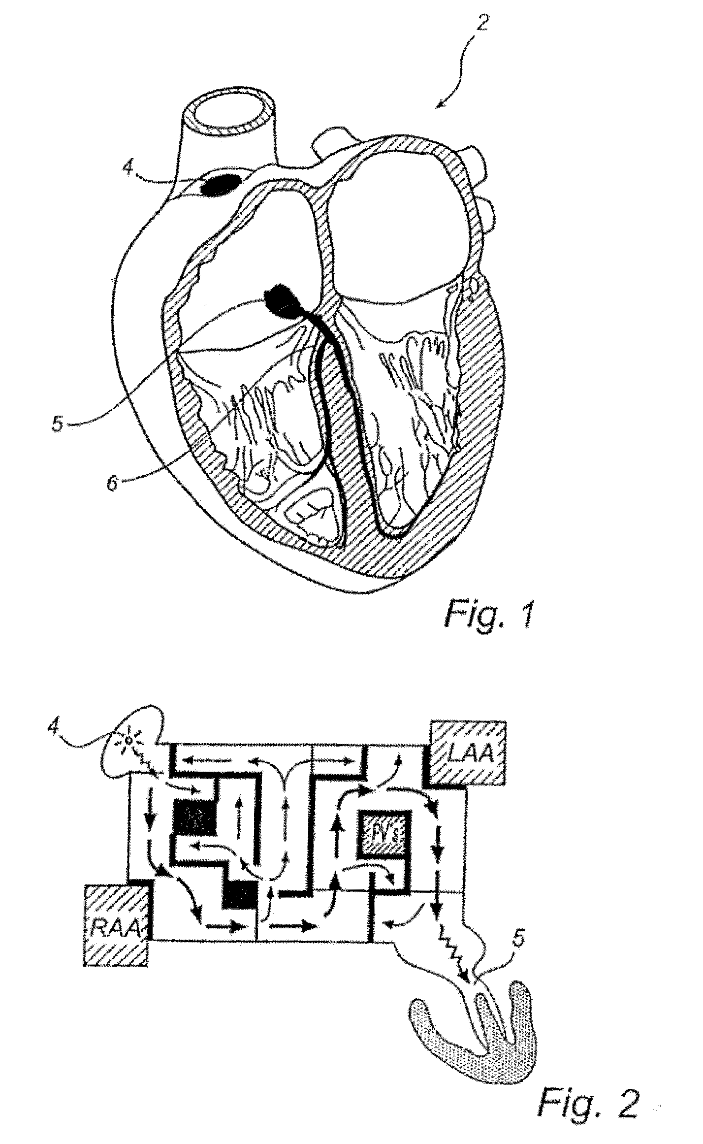 Shape-Changing Medical Device, Kit, Method Of Production, And Method Of Use