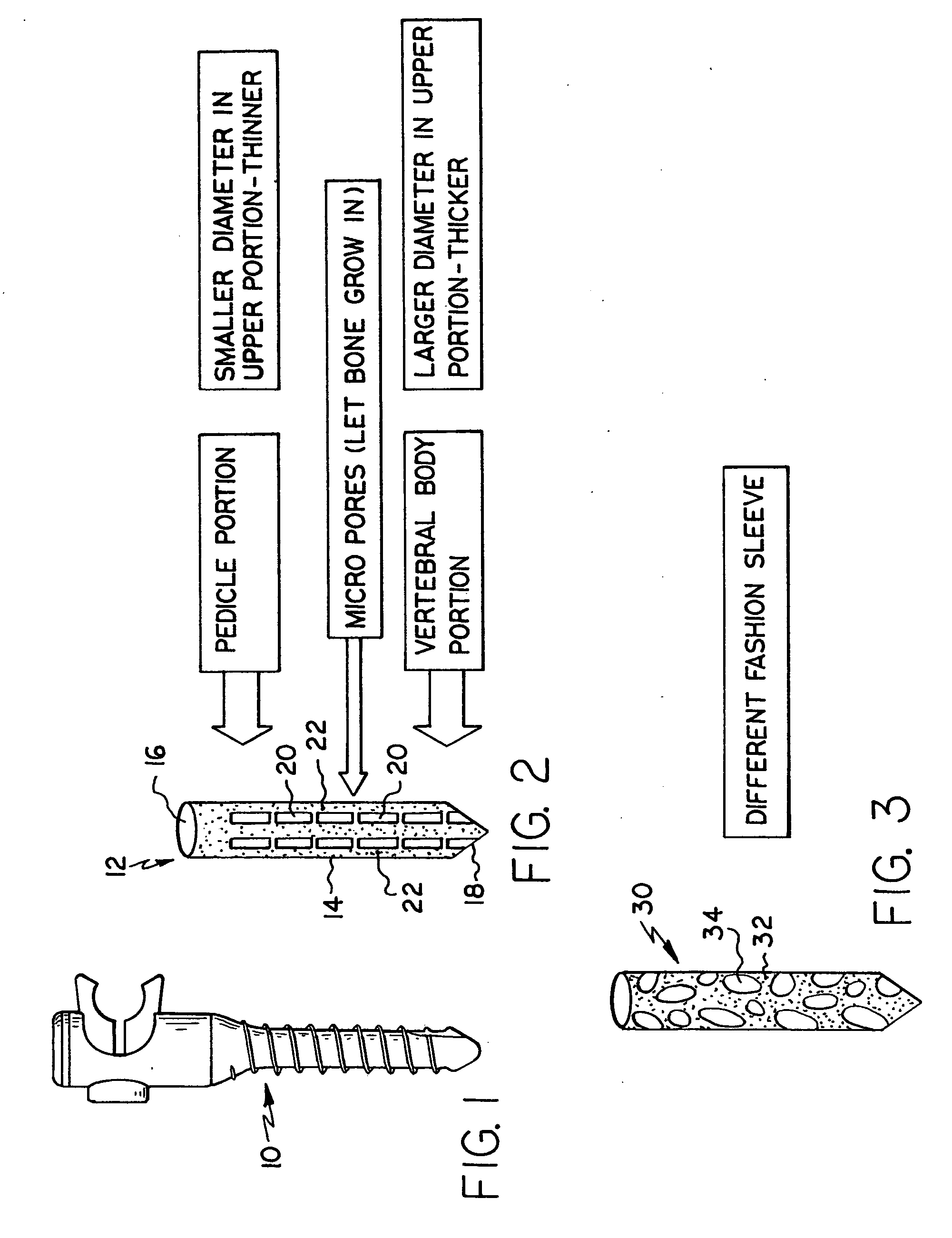Screw sleeve made of polyetheretherketone (PEEK) for augmentation of bone screw insertion in osteoporotic or revision lumbar spine instrumentation