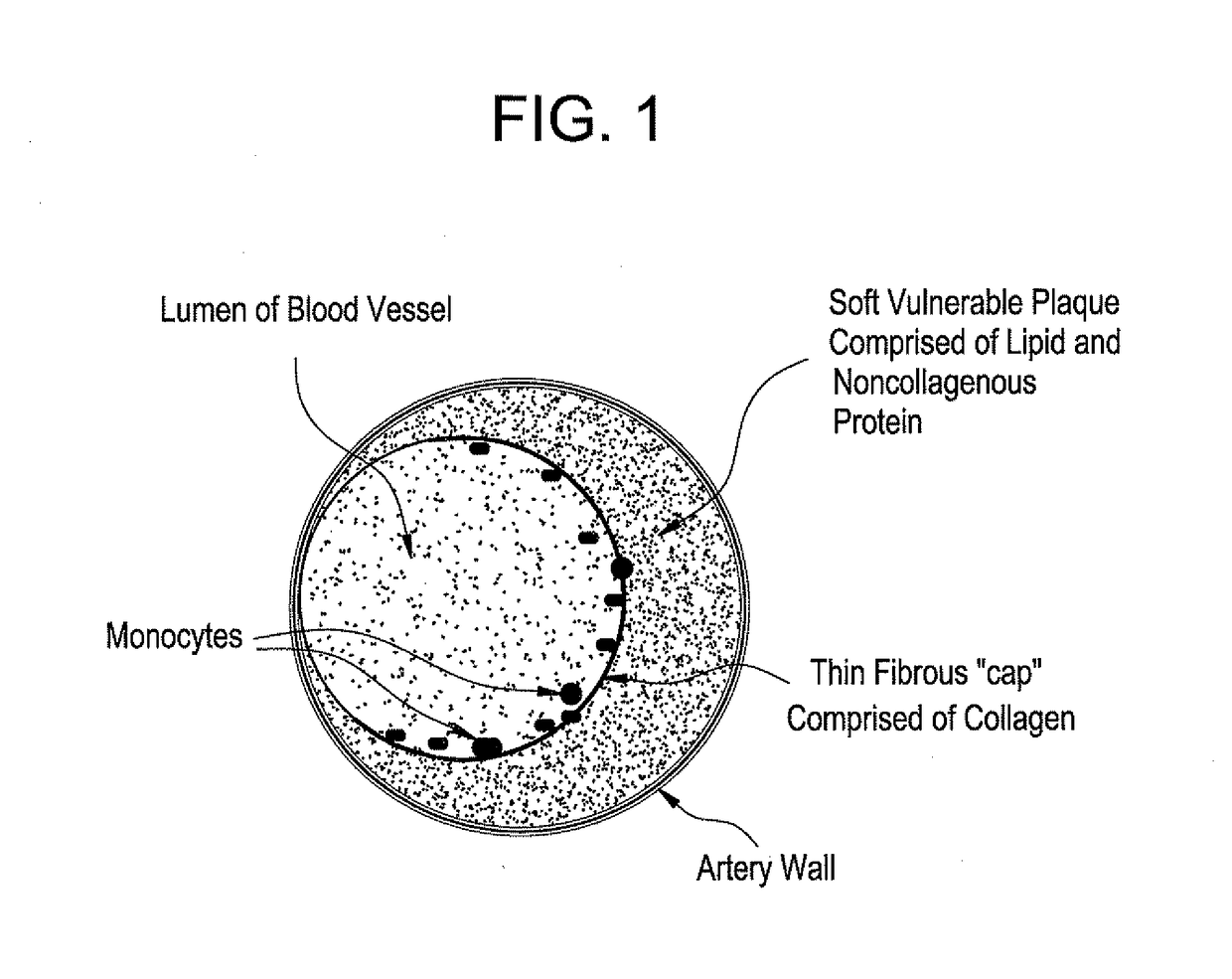 Methods and devices for treating vulnerable plaque