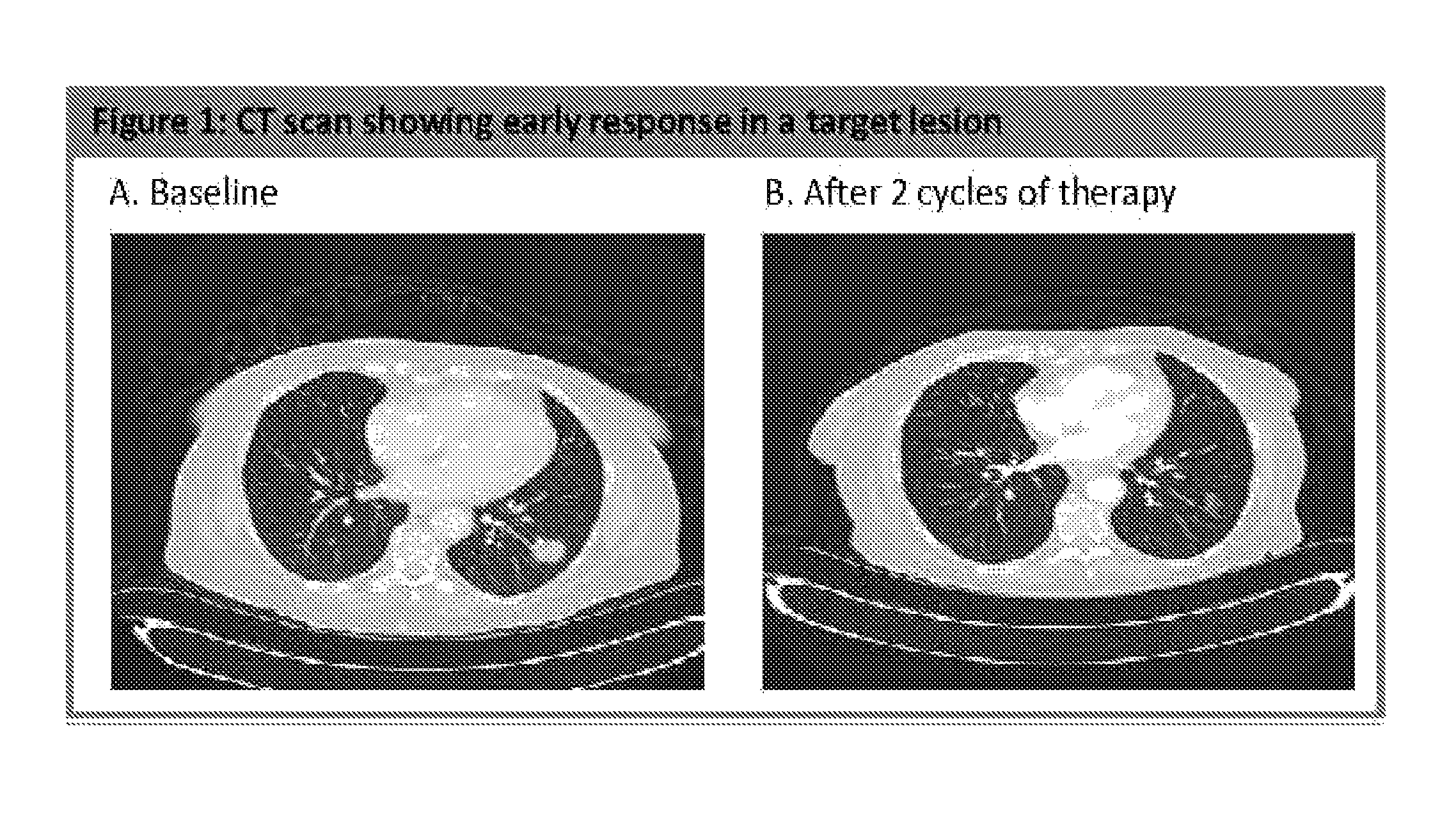 Methods of treatment of pancreatic cancer