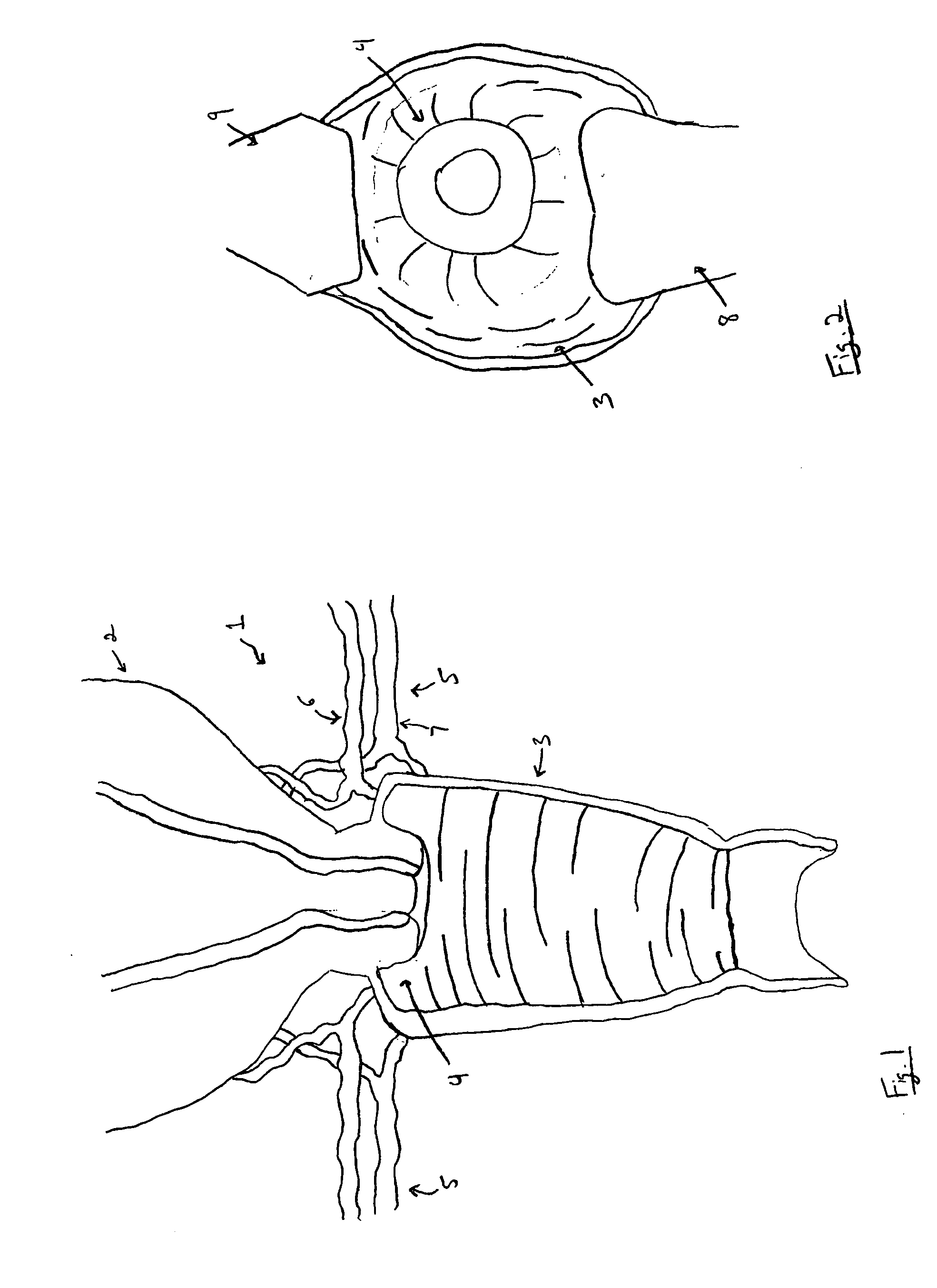 Method and device for canulation and occlusion of uterine arteries